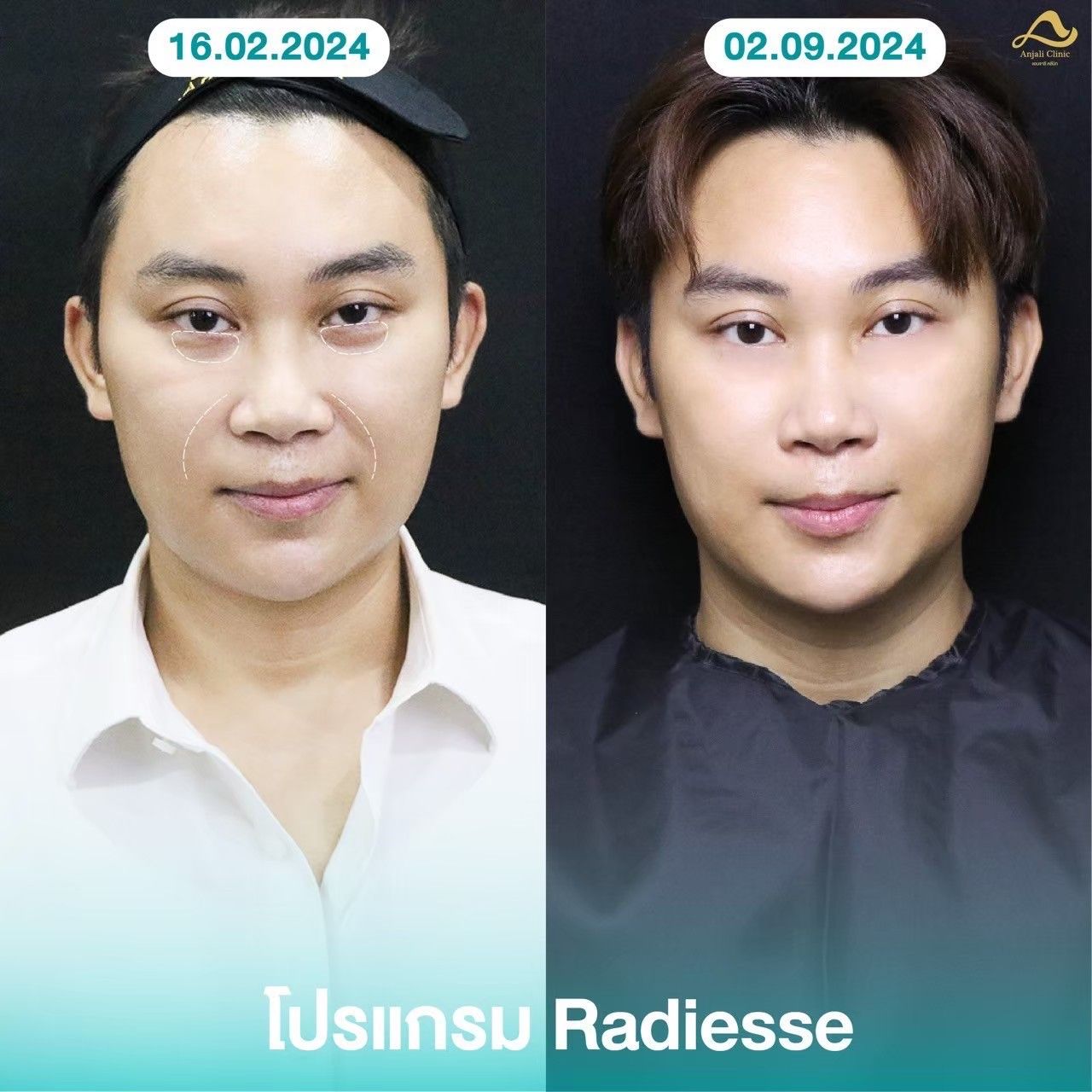 Radiesse / Radiesse + 6