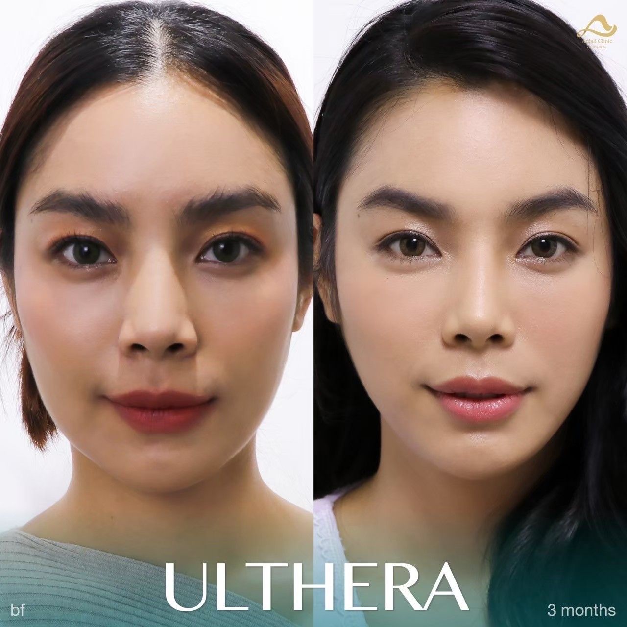 Ulthera Prime / SPT 8