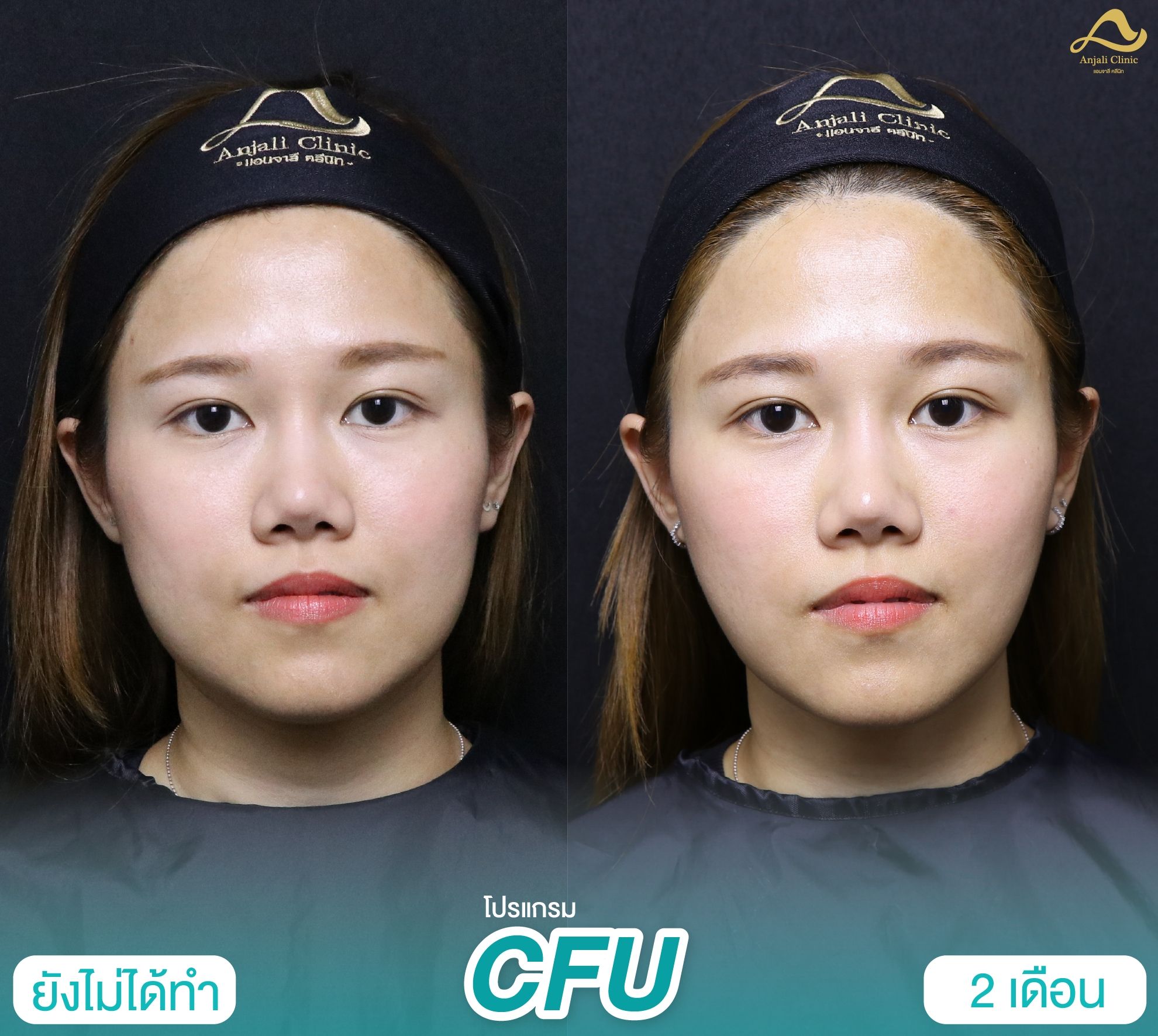 Cfu / Hifu 1