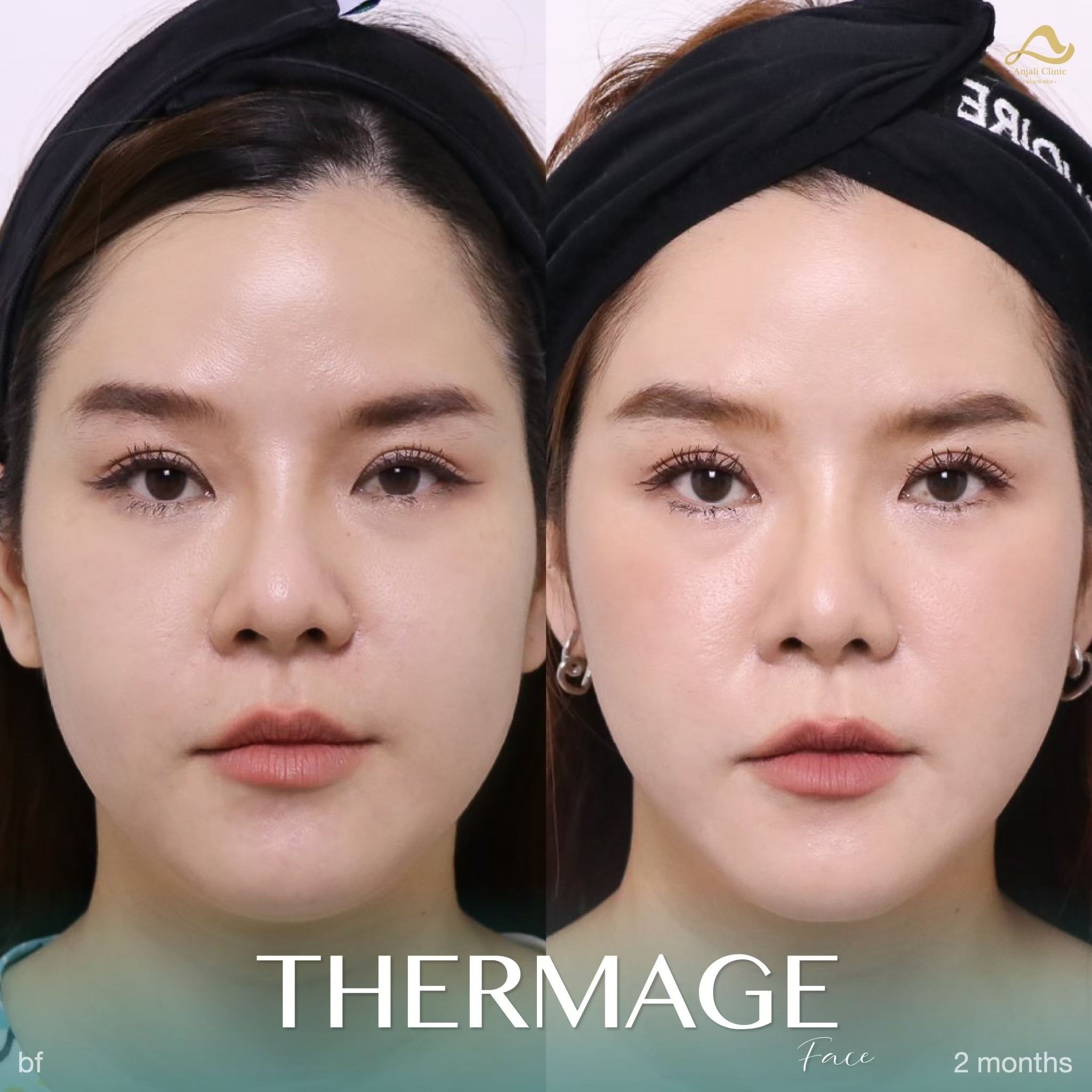 Thermage หน้า 6