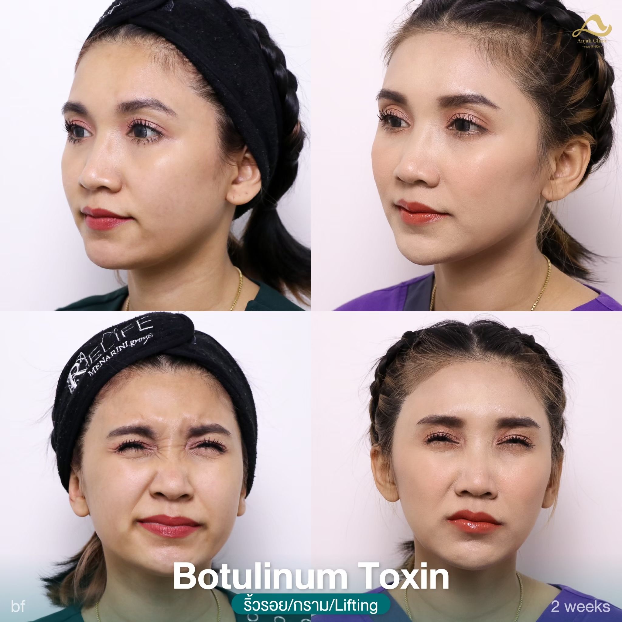 Upper Face 5