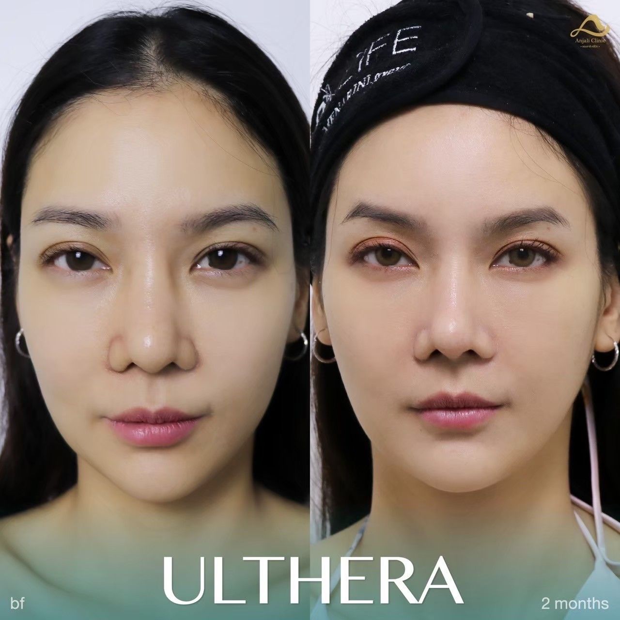 Ulthera Prime / SPT 7