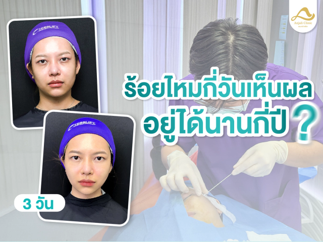 ร้อยไหมกี่วันเห็นผล อยู่ได้นานกี่ปี ?