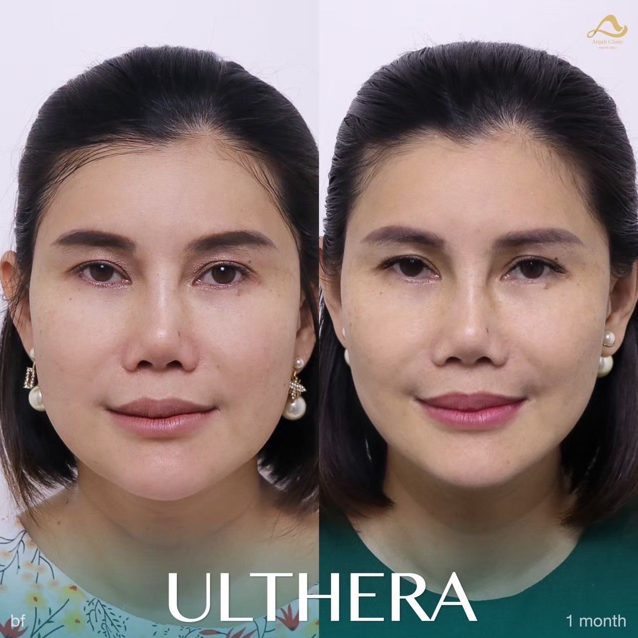 Ulthera Prime / SPT 11