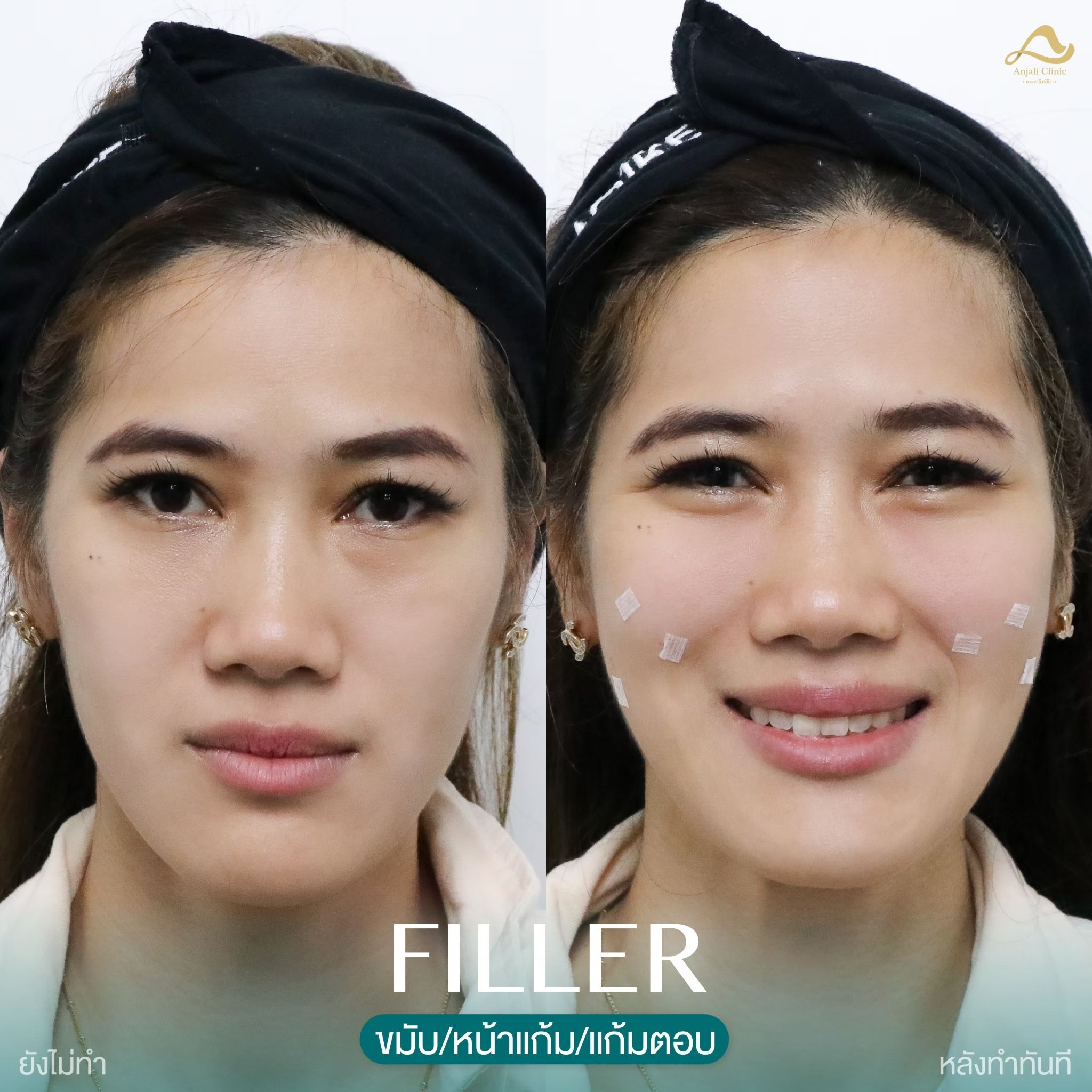 แก้ม 6