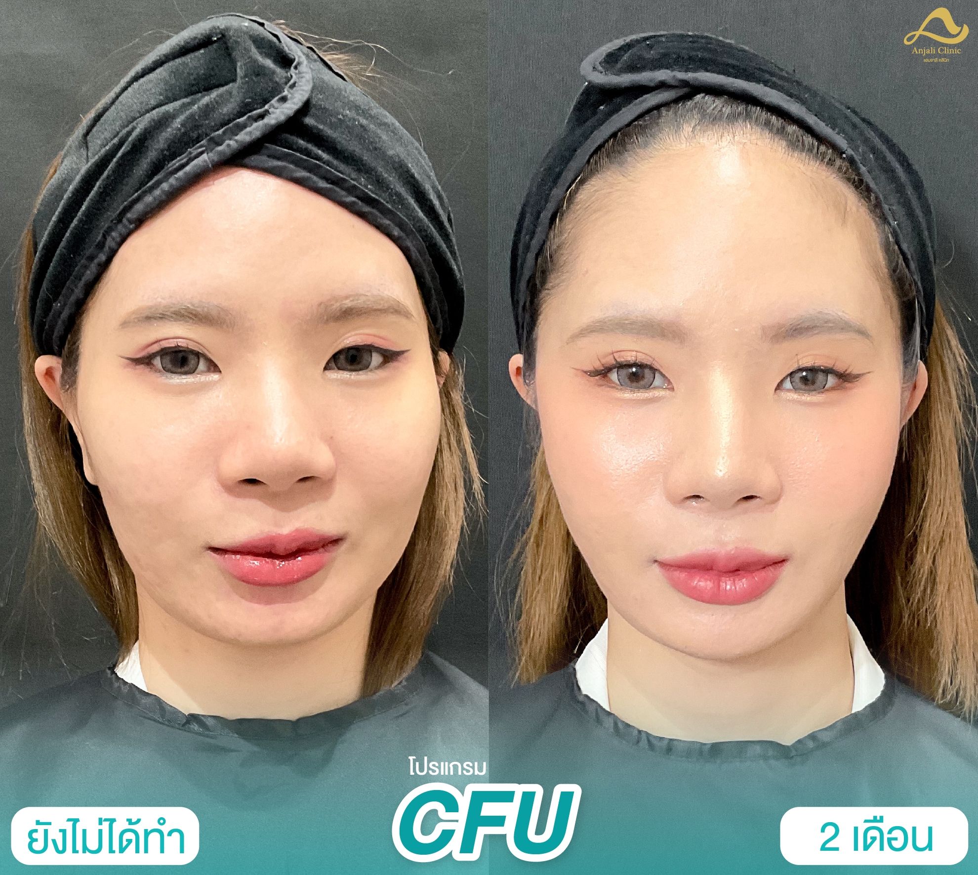 Cfu / Hifu 8