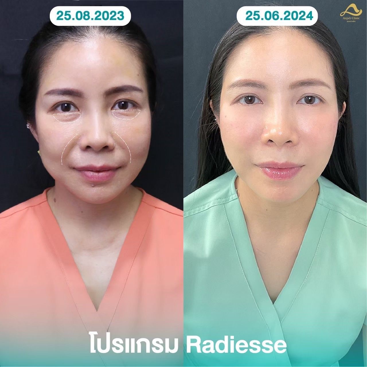 Radiesse / Radiesse + 9