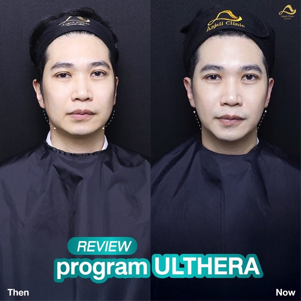 Ulthera Prime / SPT 5
