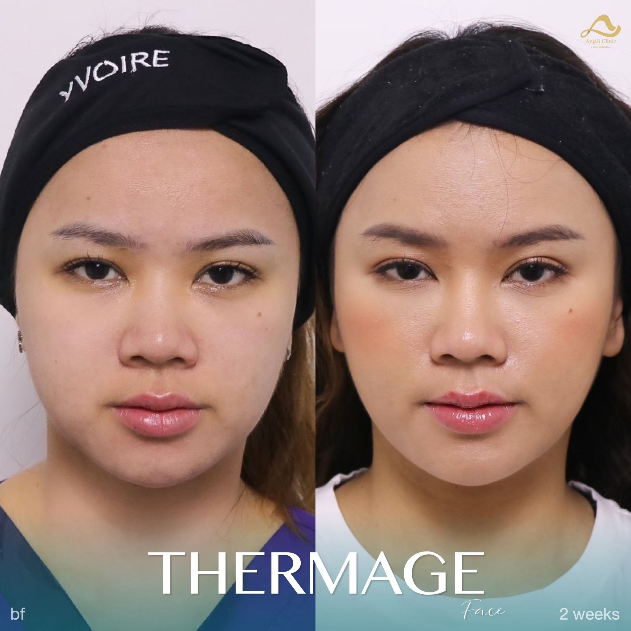 Thermage หน้า 4