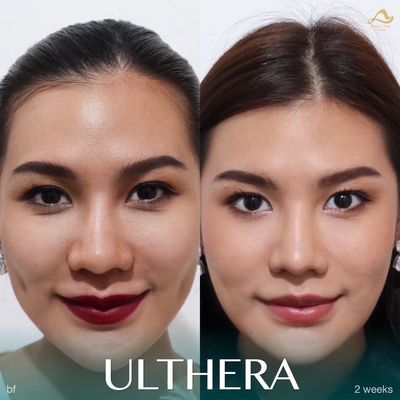 Ulthera Prime / SPT 9