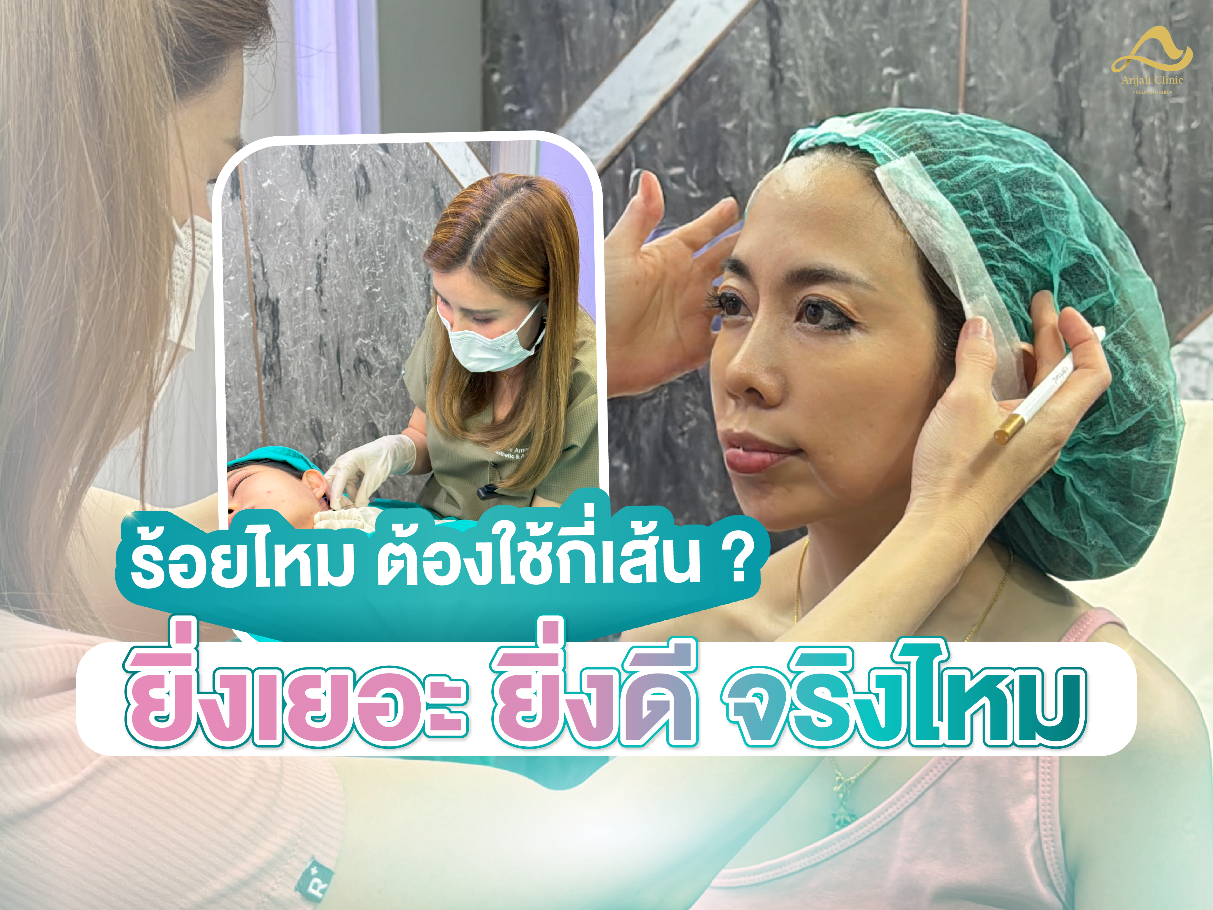 ปกติร้อยไหม ต้องใช้กี่เส้น? ยิ่งเยอะ ยิ่งดีจริงเหรอ?