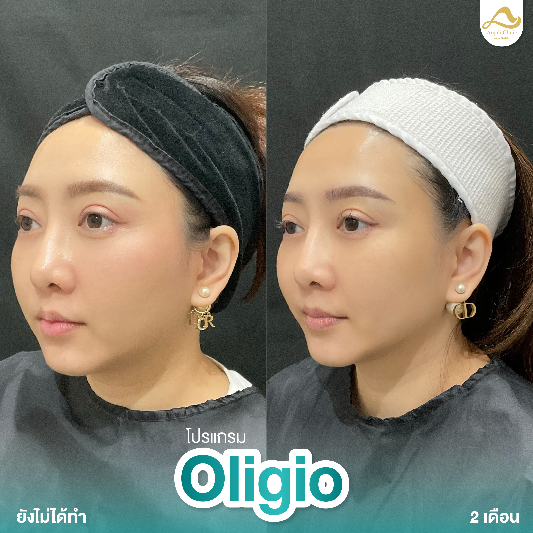 Oligio 10