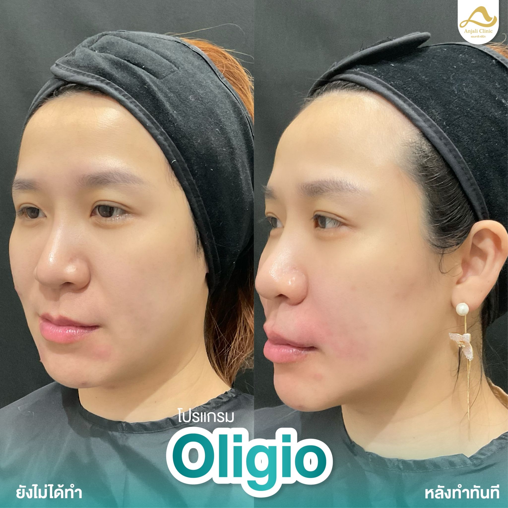Oligio 4