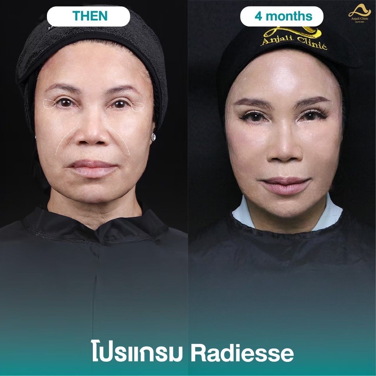 Radiesse / Radiesse + 10