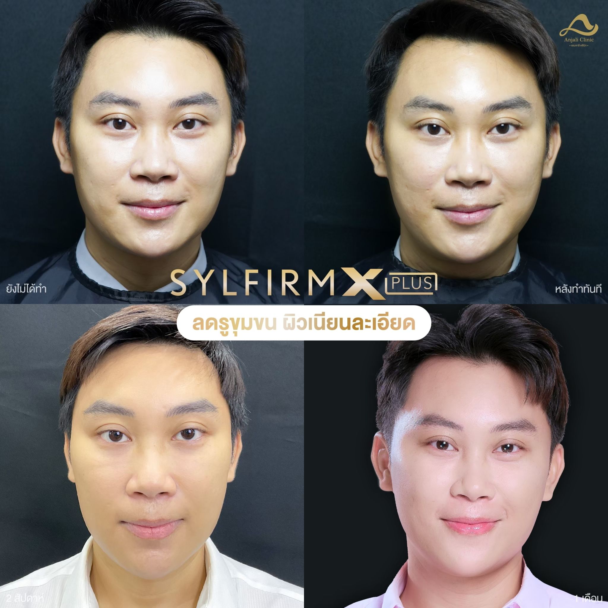 Sylfirm X 3