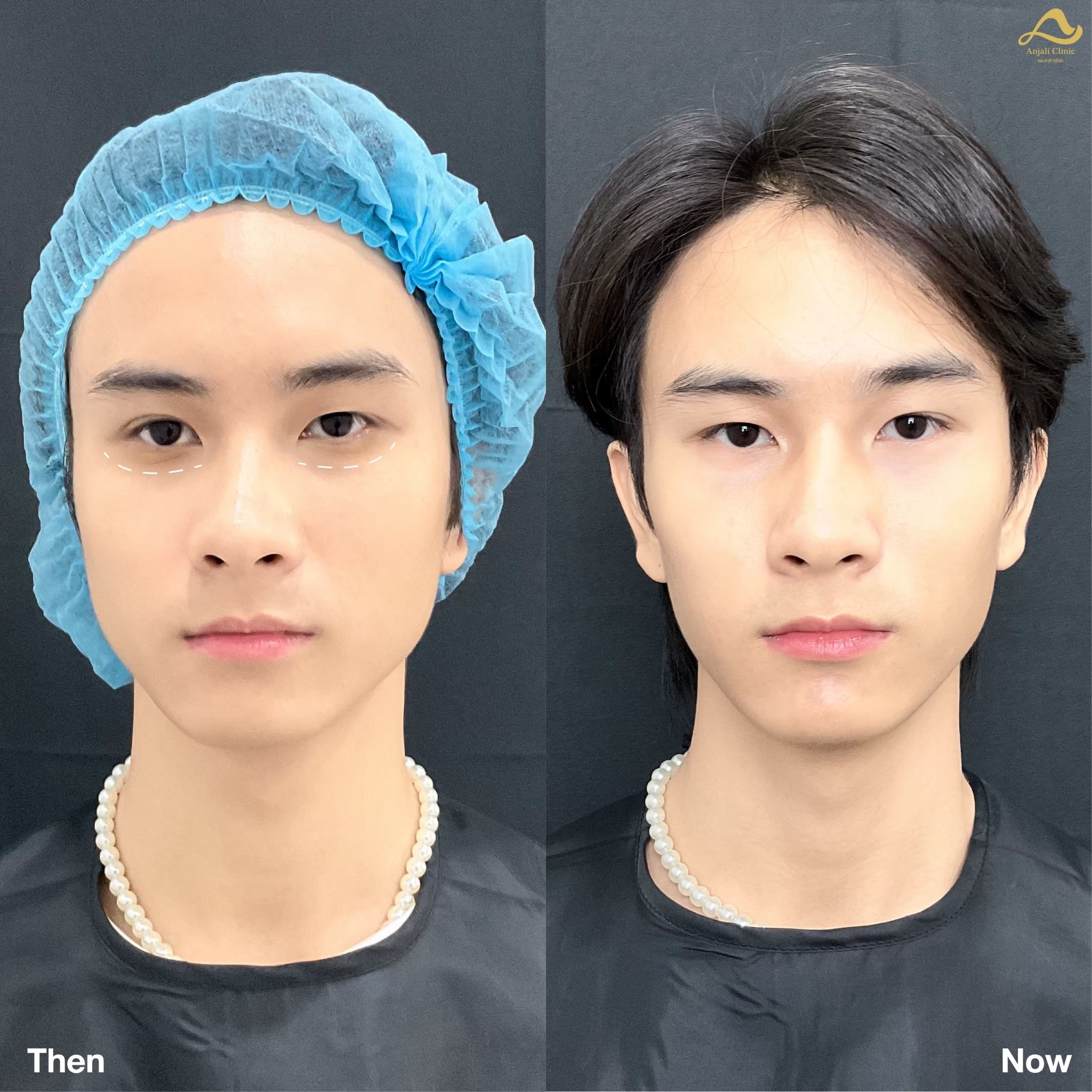 ใต้ตา 2