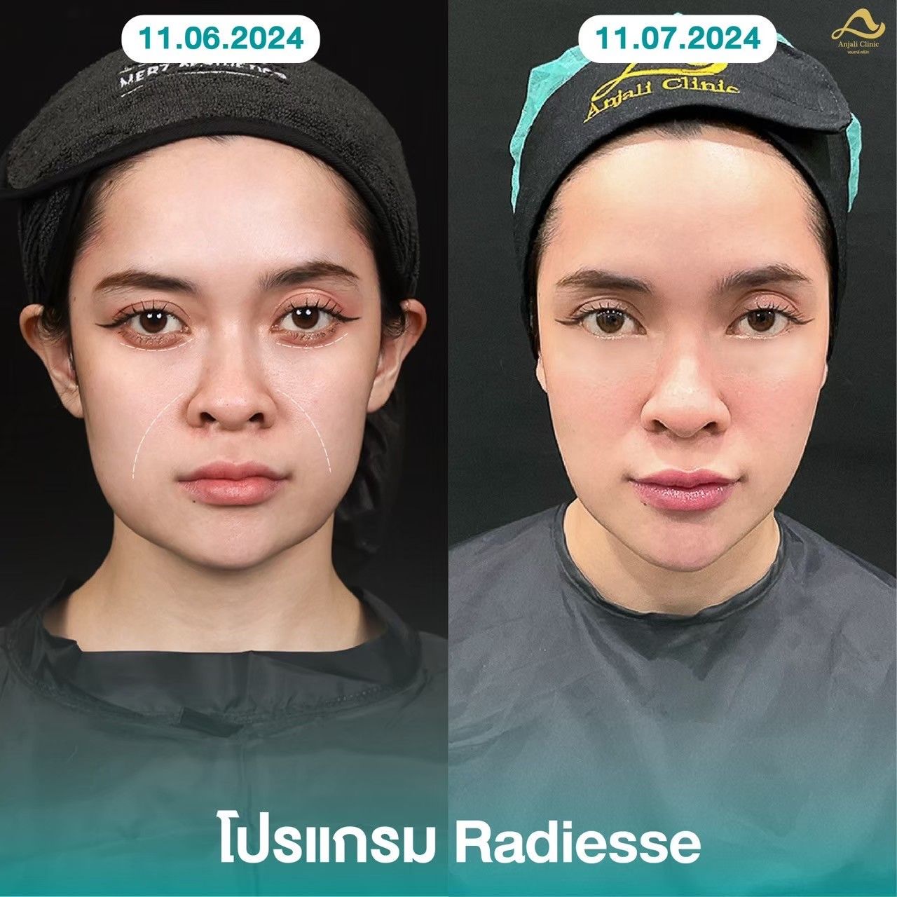 Radiesse / Radiesse + 7