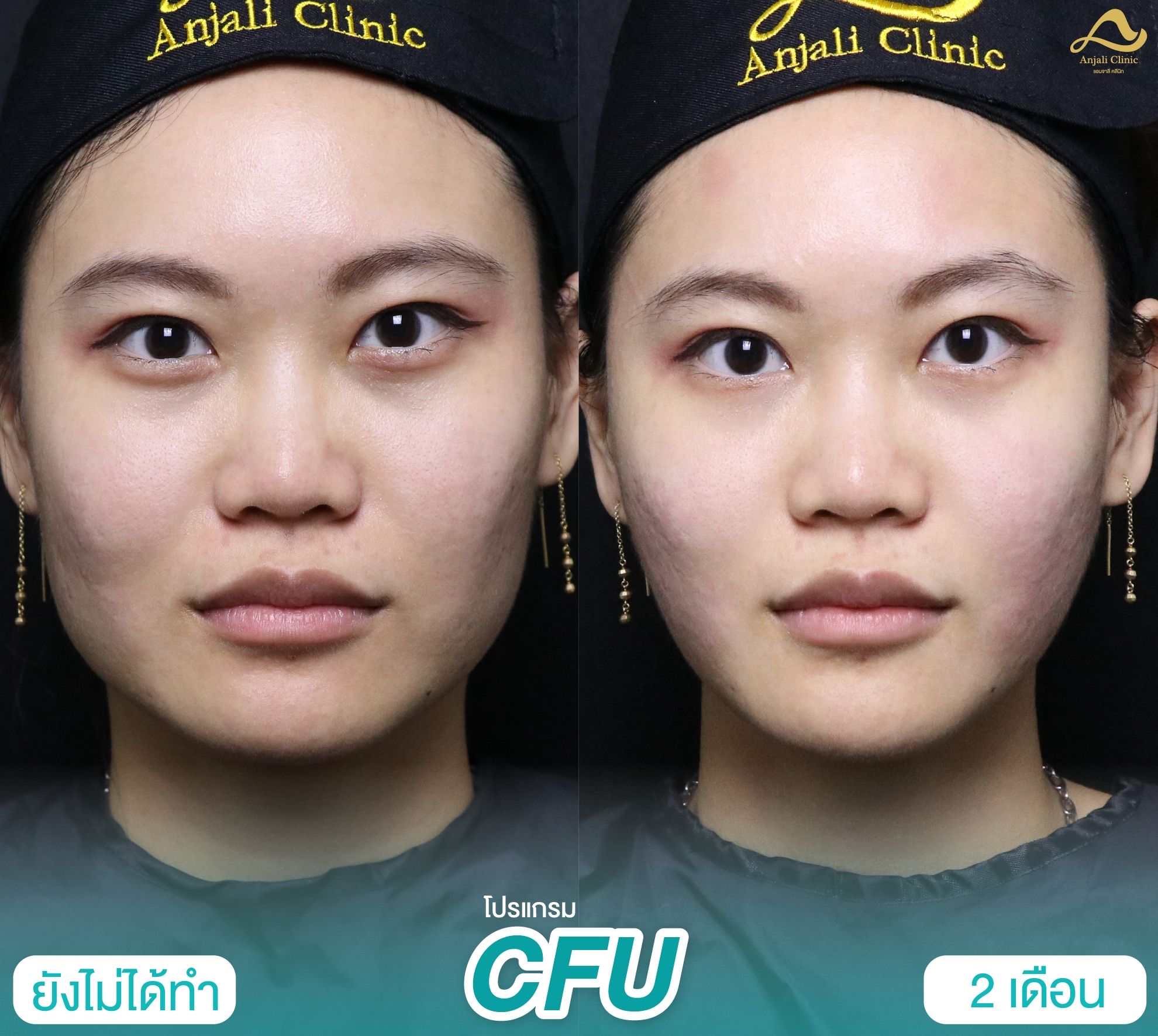 Cfu / Hifu 2