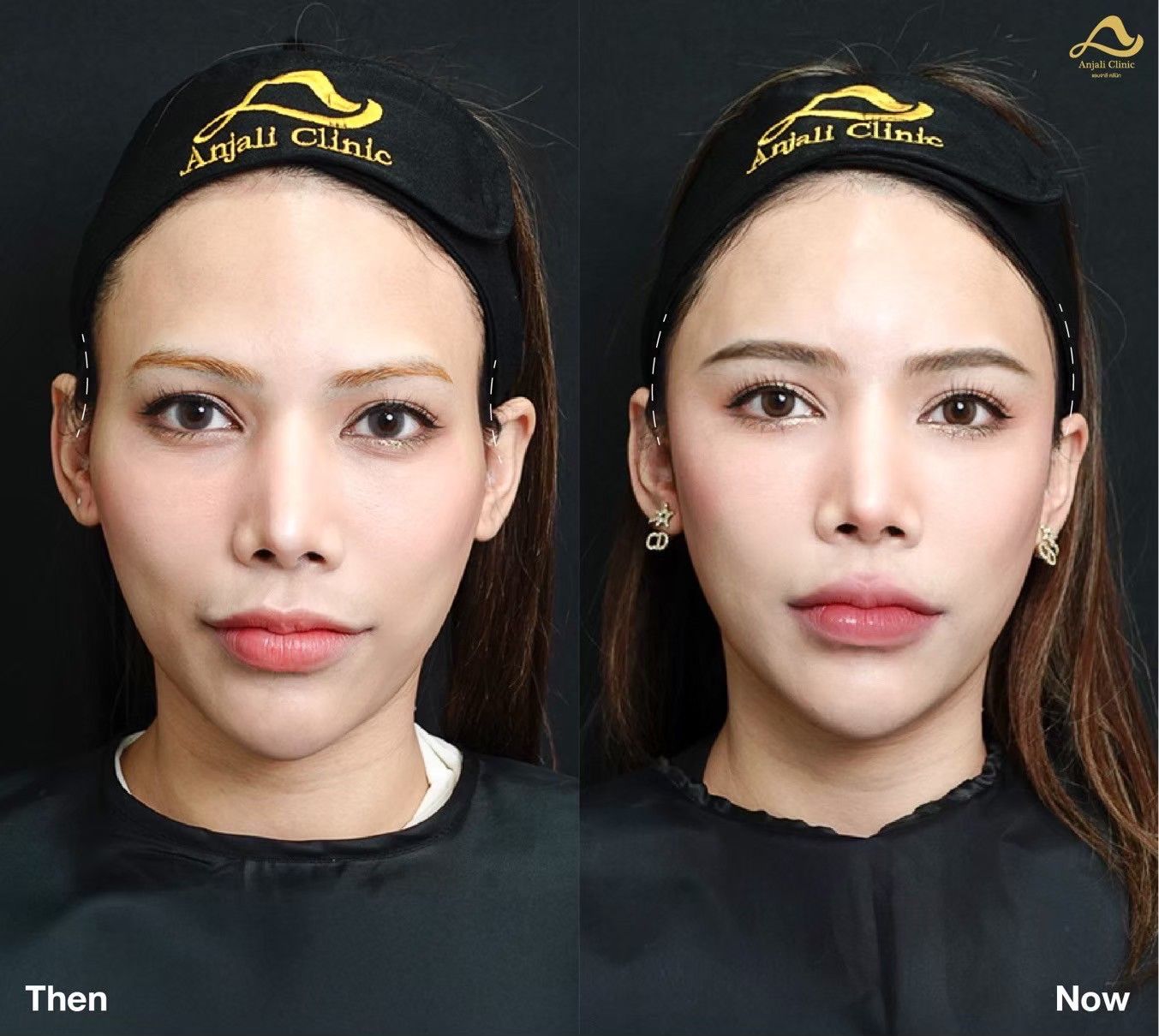 แก้ม 4