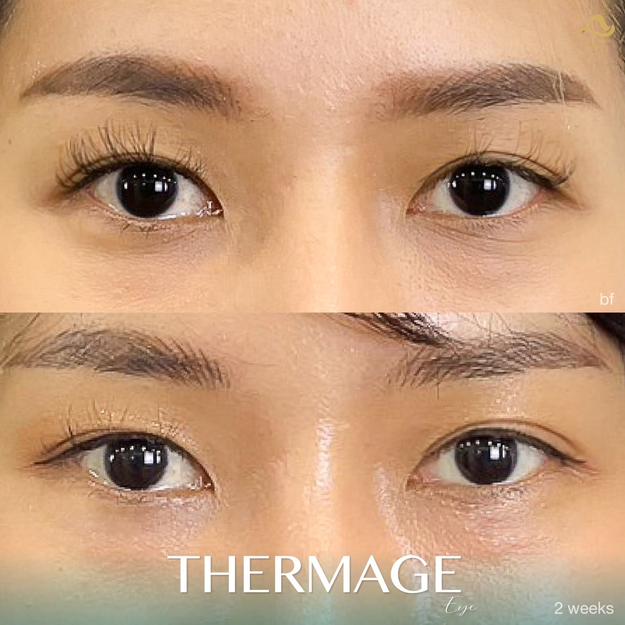 Thermage หน้า 11