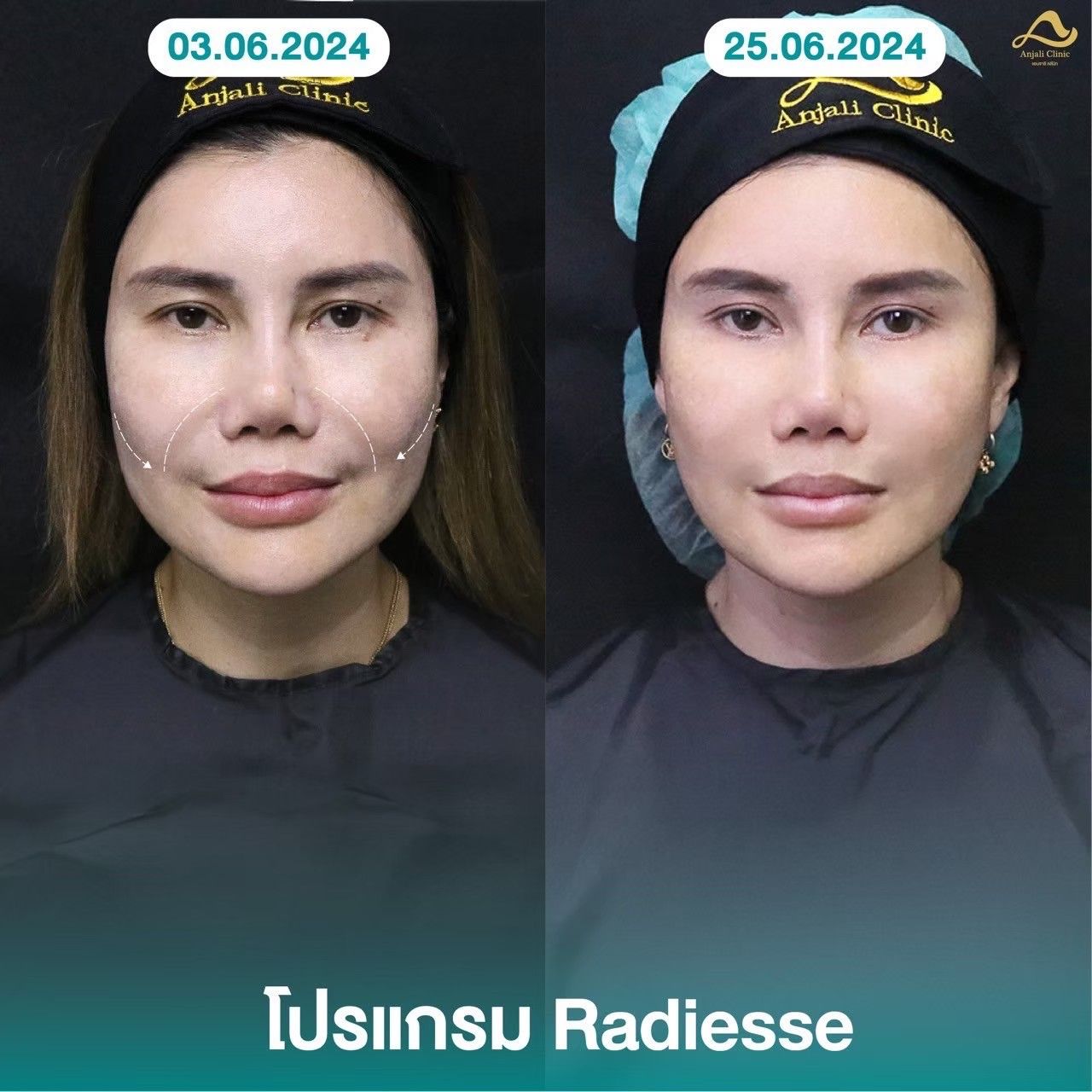 Radiesse / Radiesse + 4