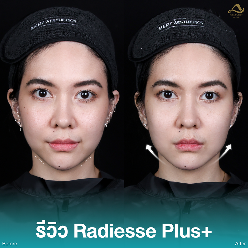 Radiesse / Radiesse + 1