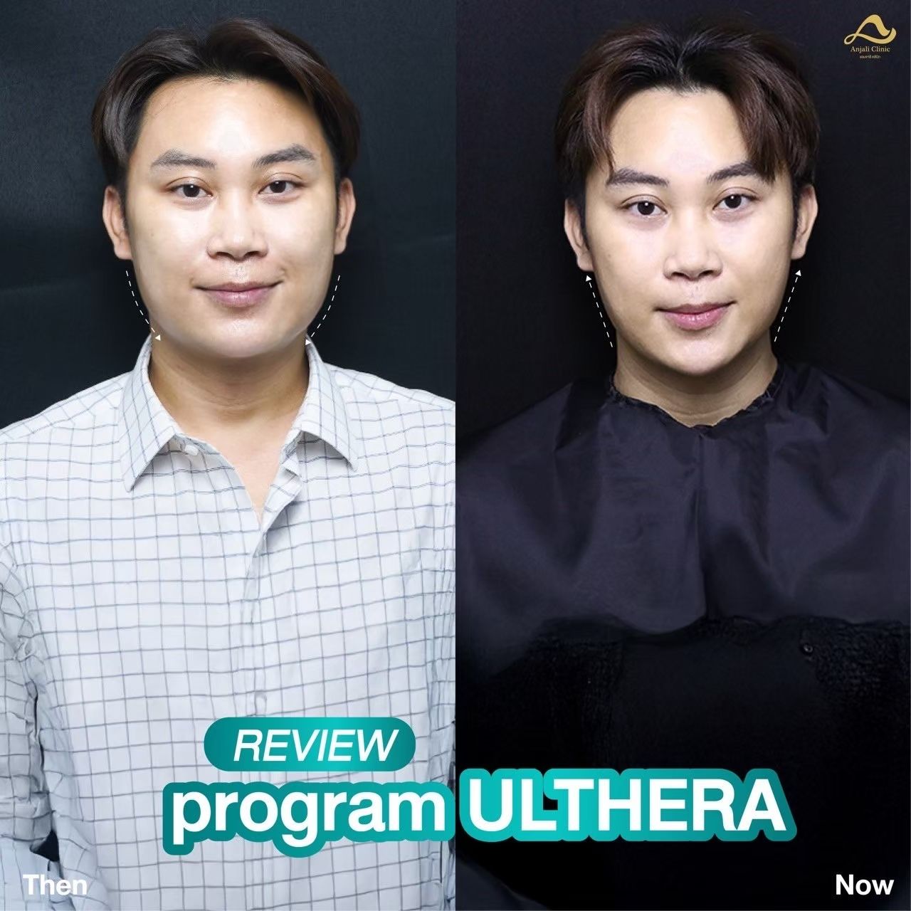 Ulthera Prime / SPT 4