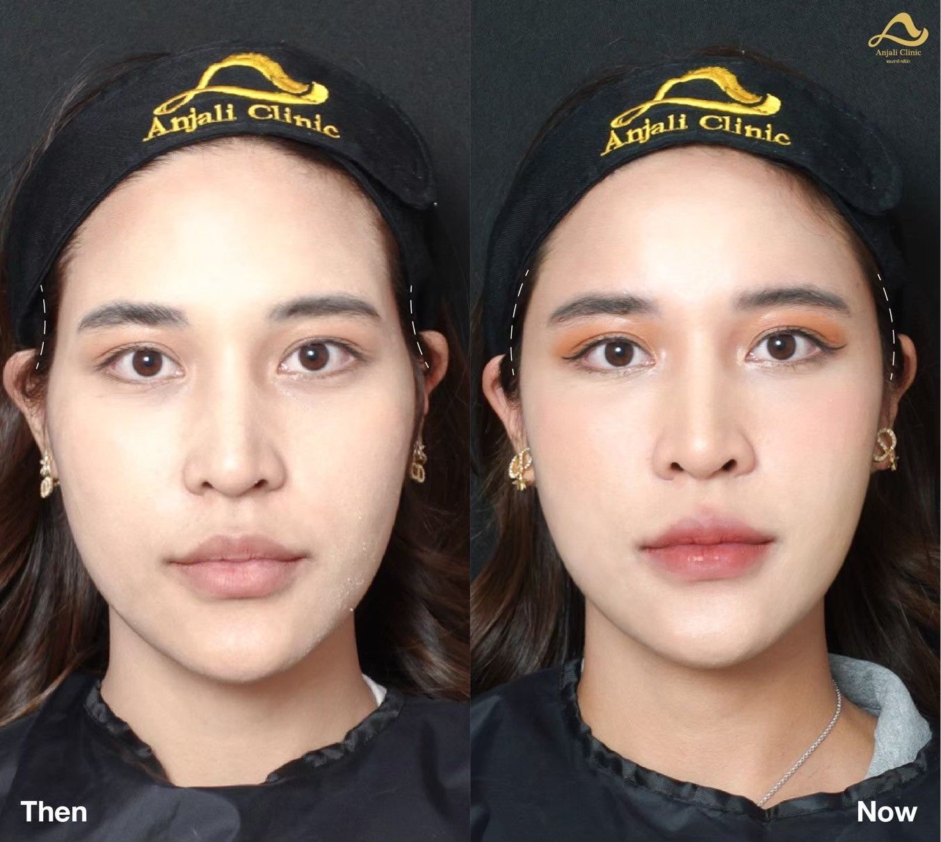 แก้ม 3