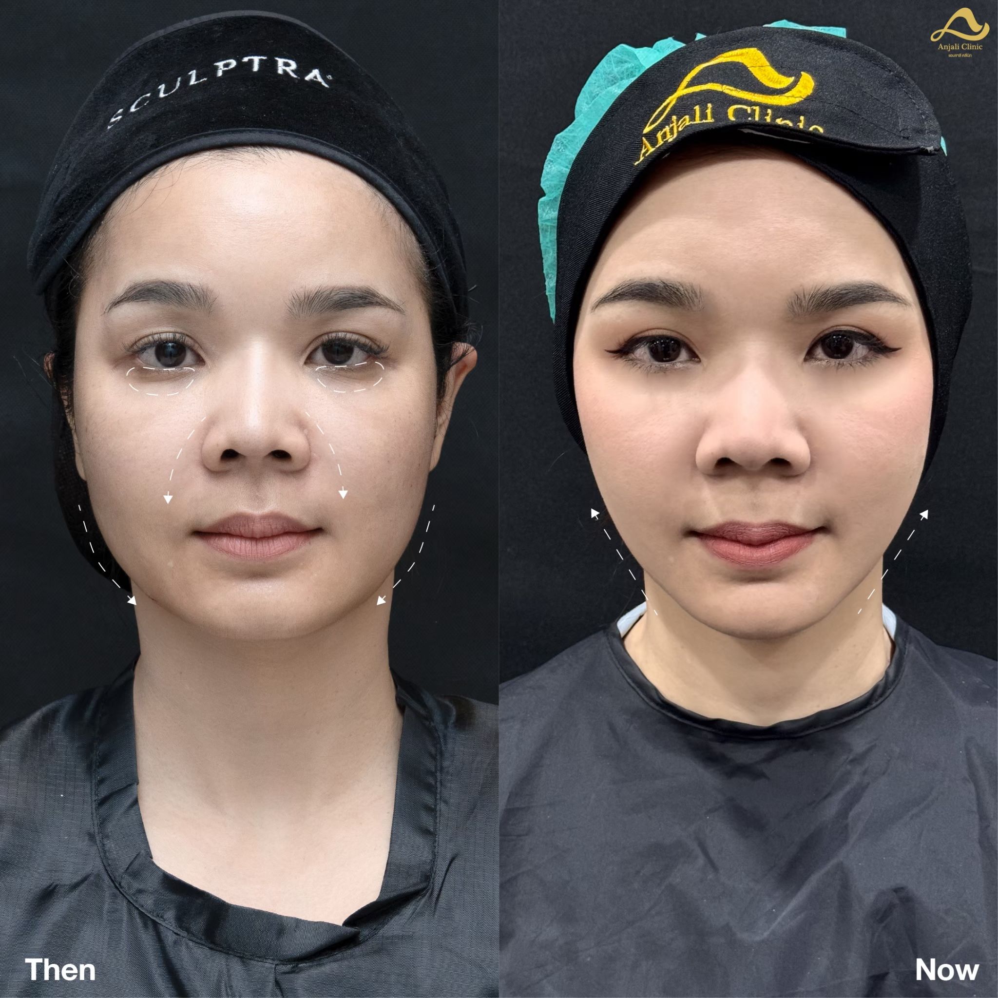 Sculptra 5