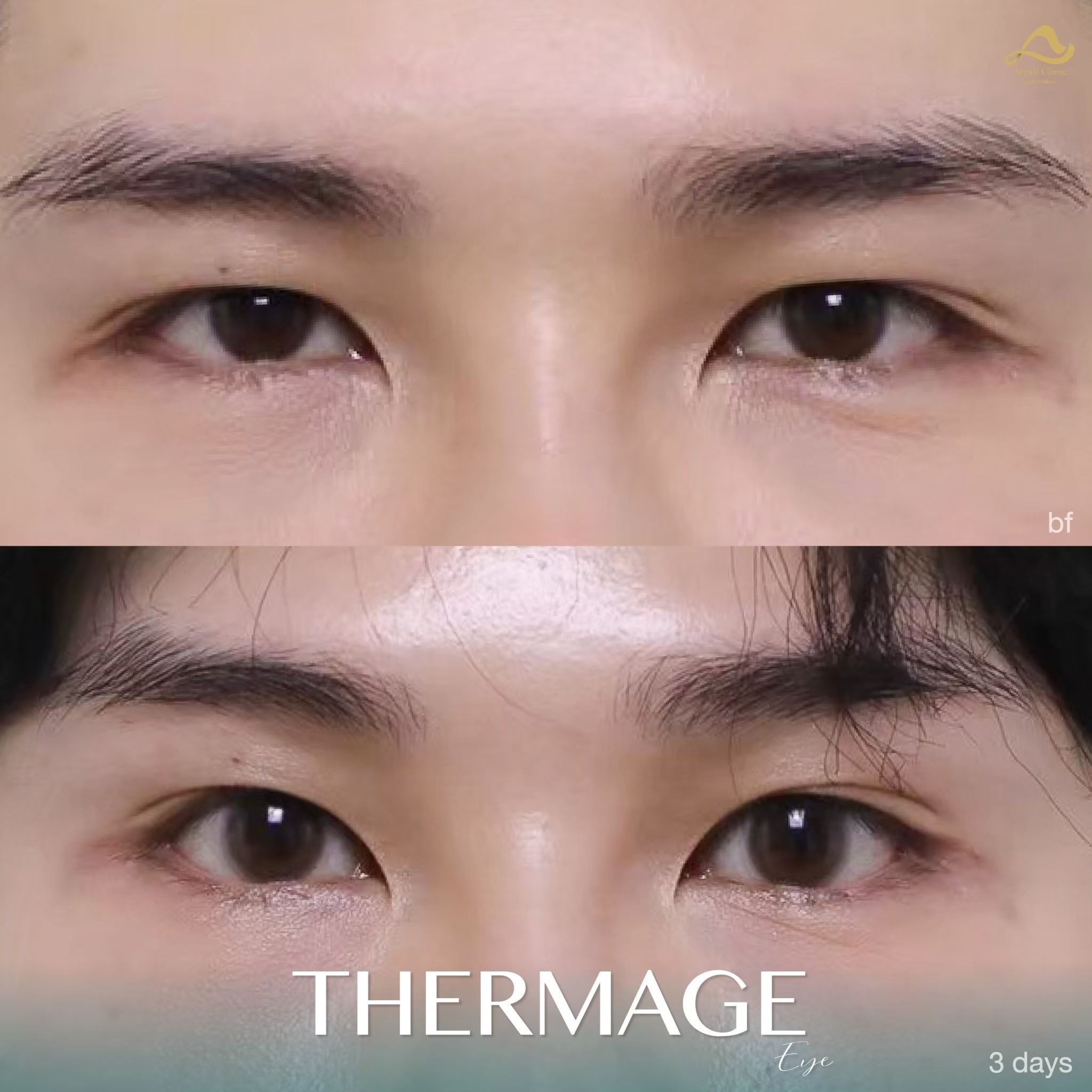 Thermage หน้า 10