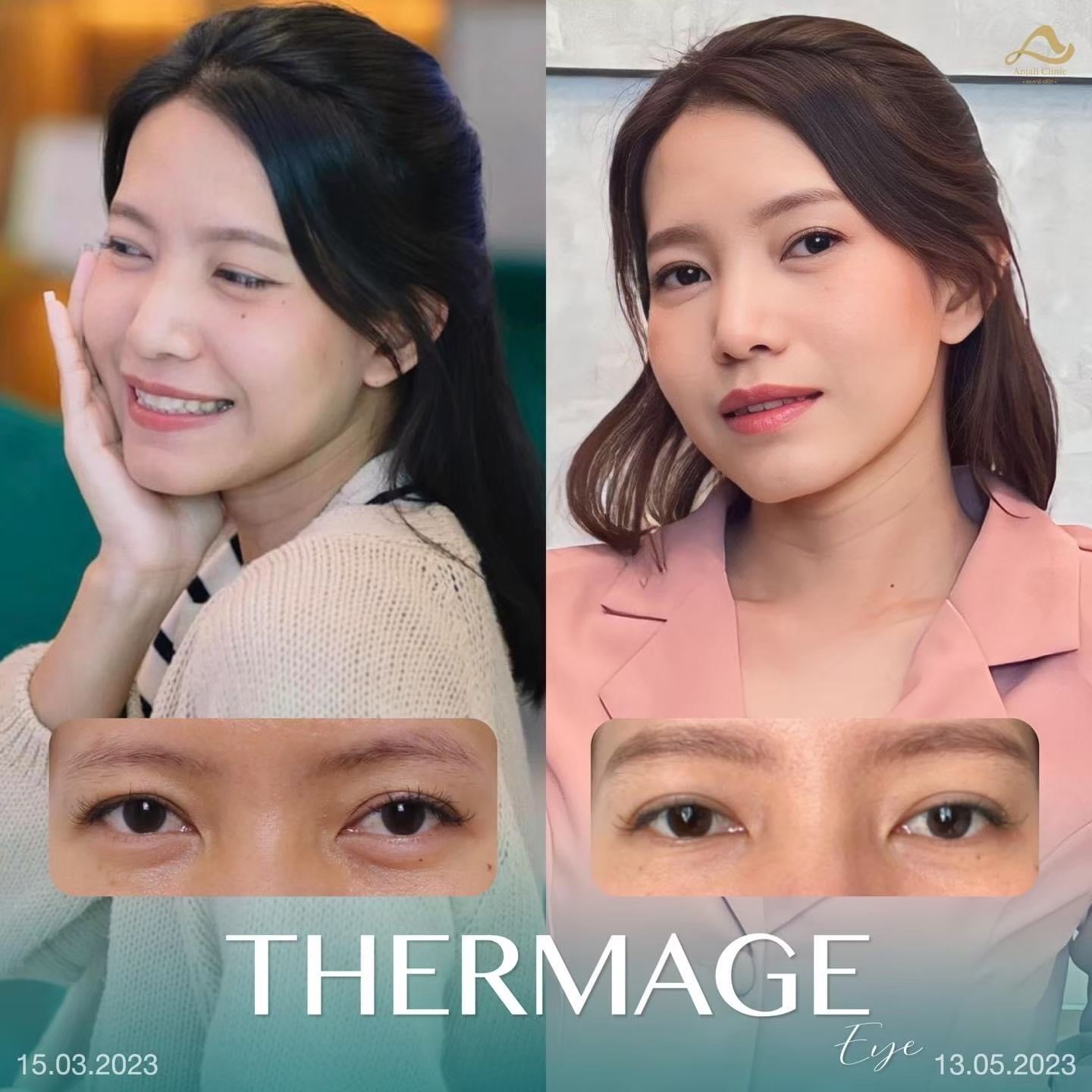 Thermage หน้า 8
