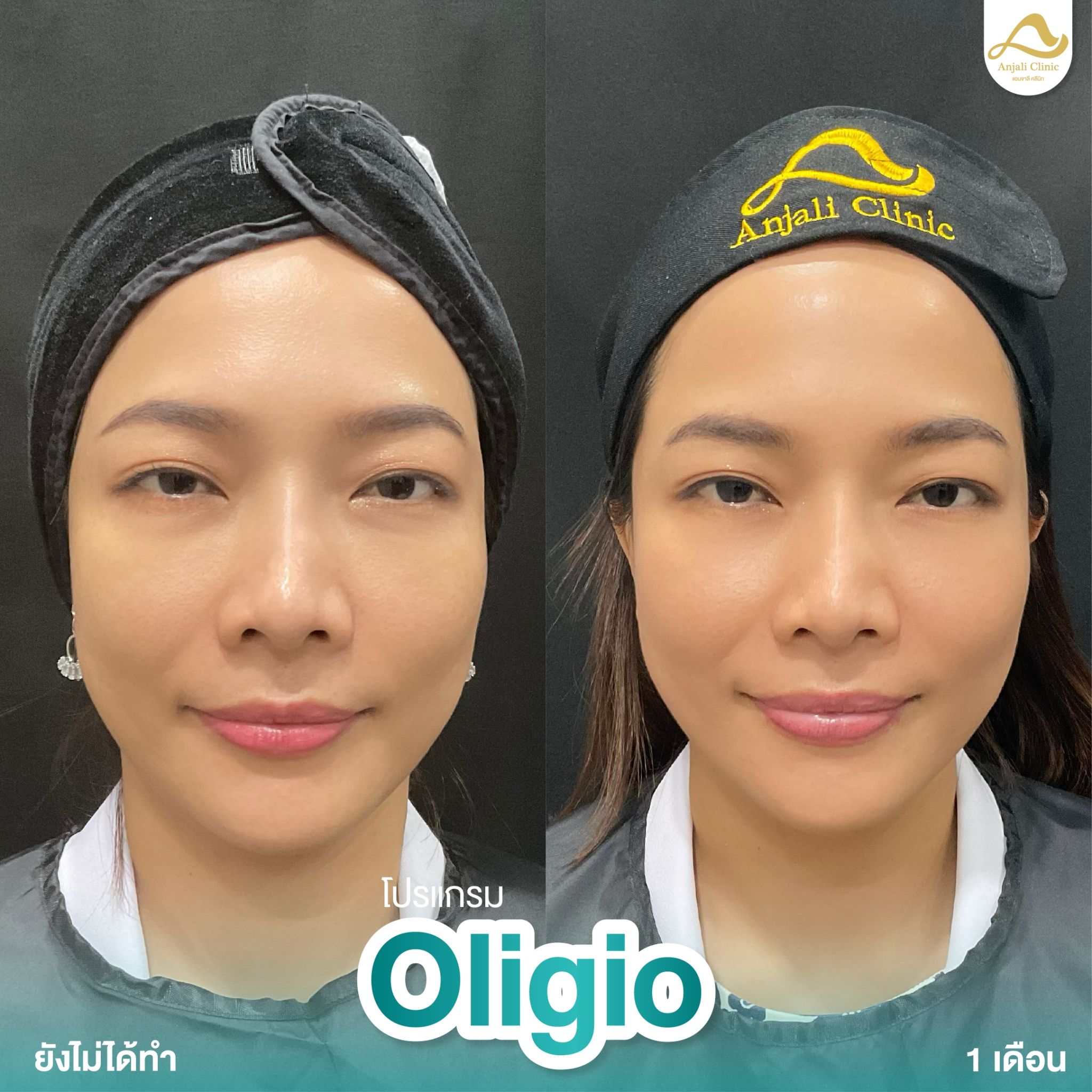 Oligio 1