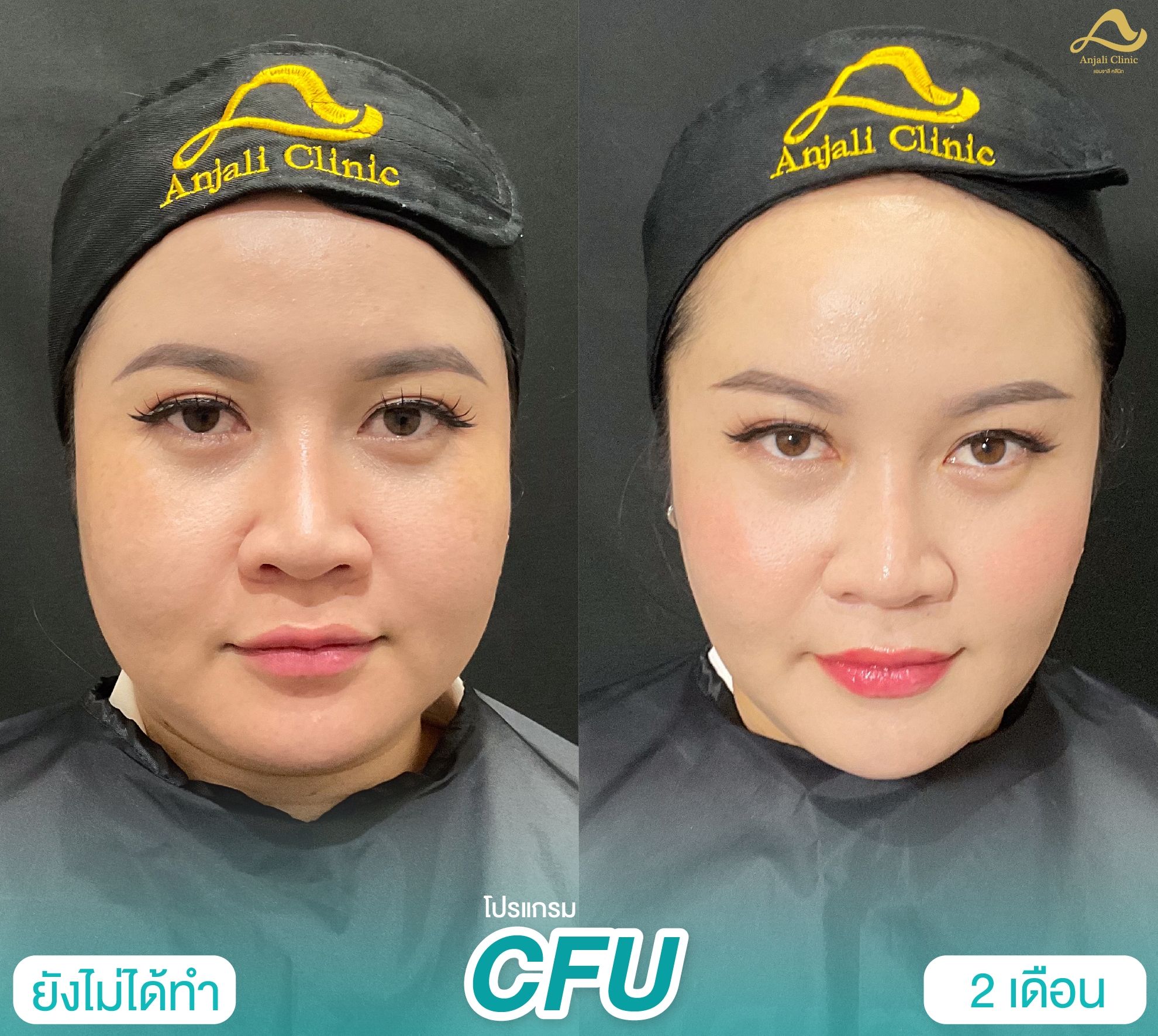 Cfu / Hifu 5
