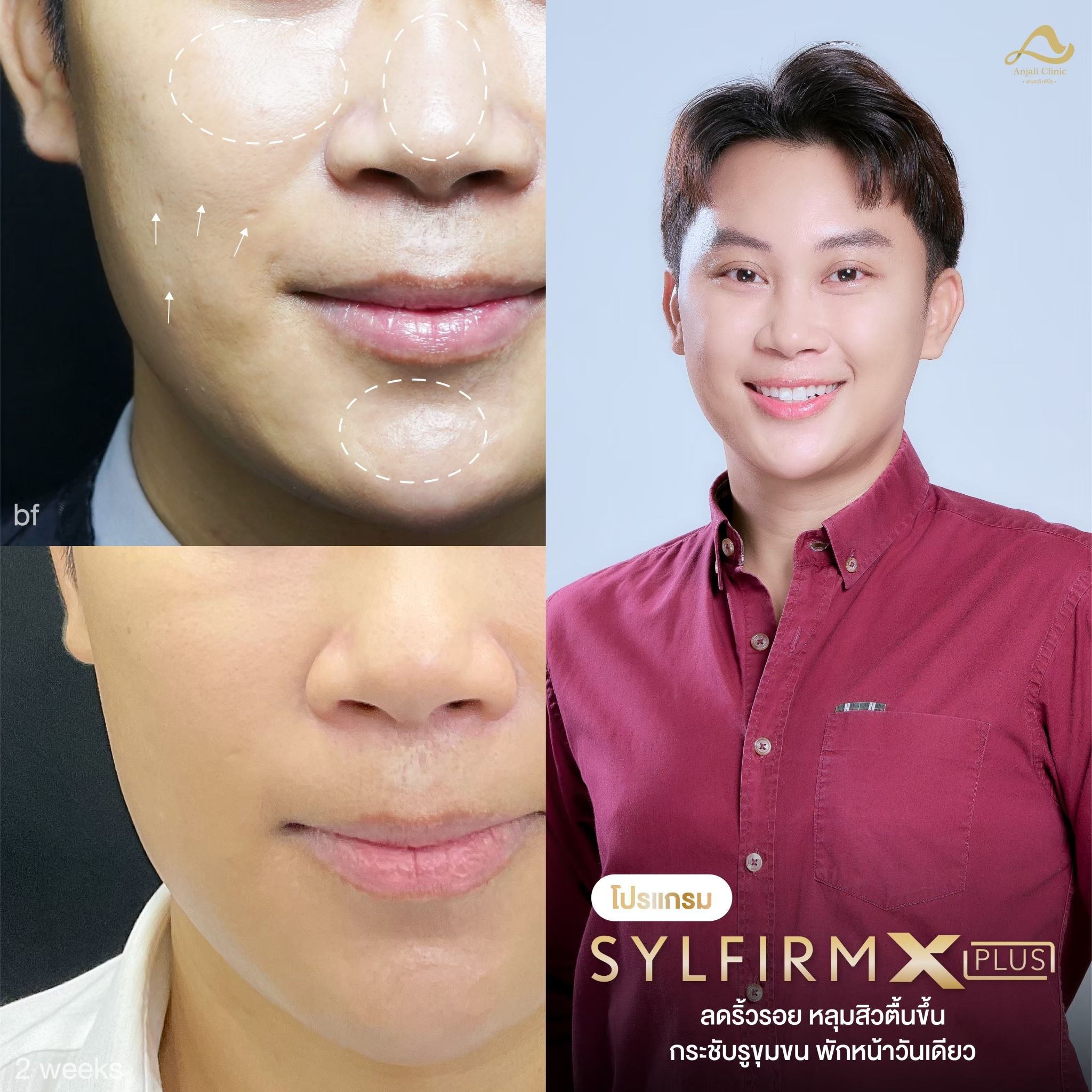 Sylfirm X 4