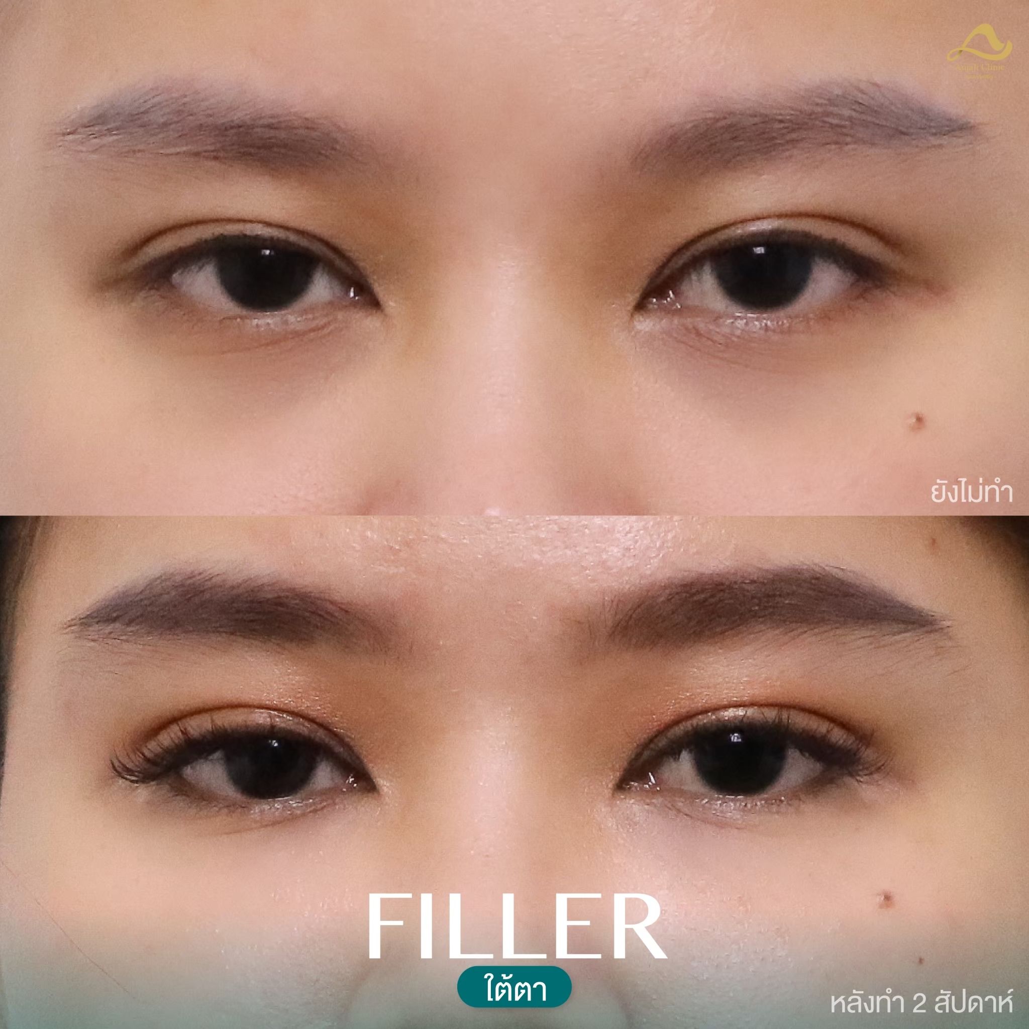 ใต้ตา 3