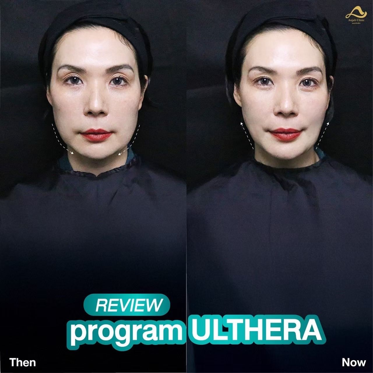 Ulthera Prime / SPT 3
