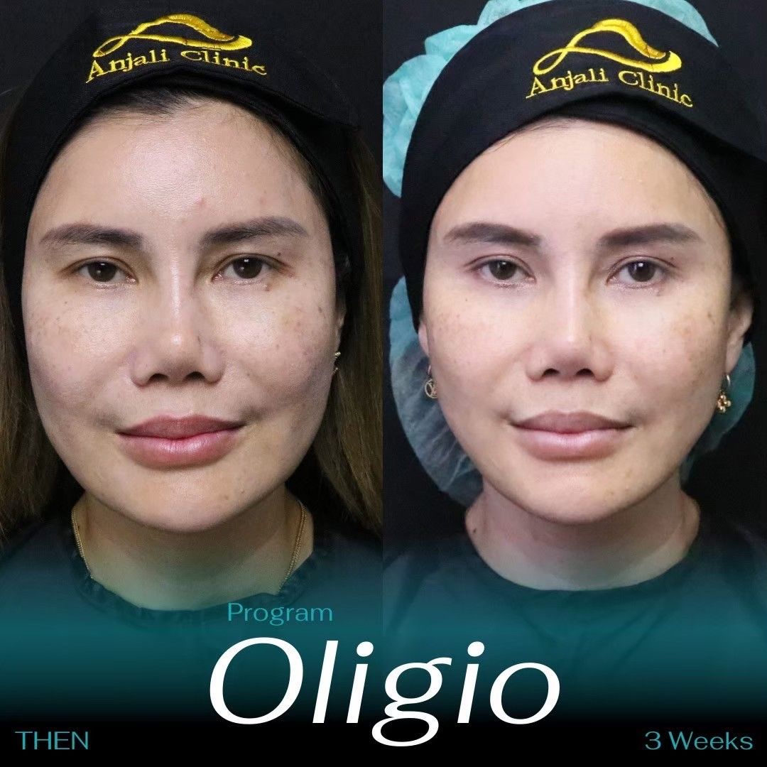 Oligio 13