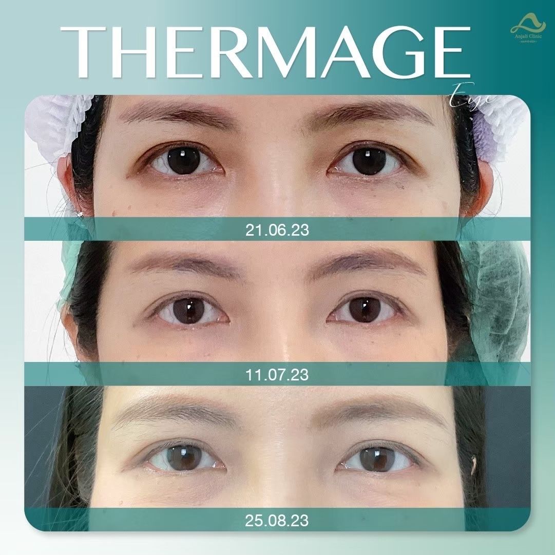 Thermage หน้า 9