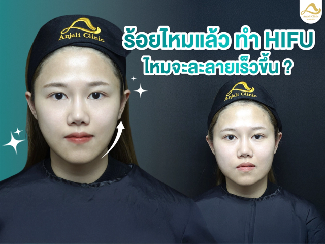 ร้อยไหมแล้ว ทำ HIFU ไหมจะละลายเร็วขึ้นไหม ?