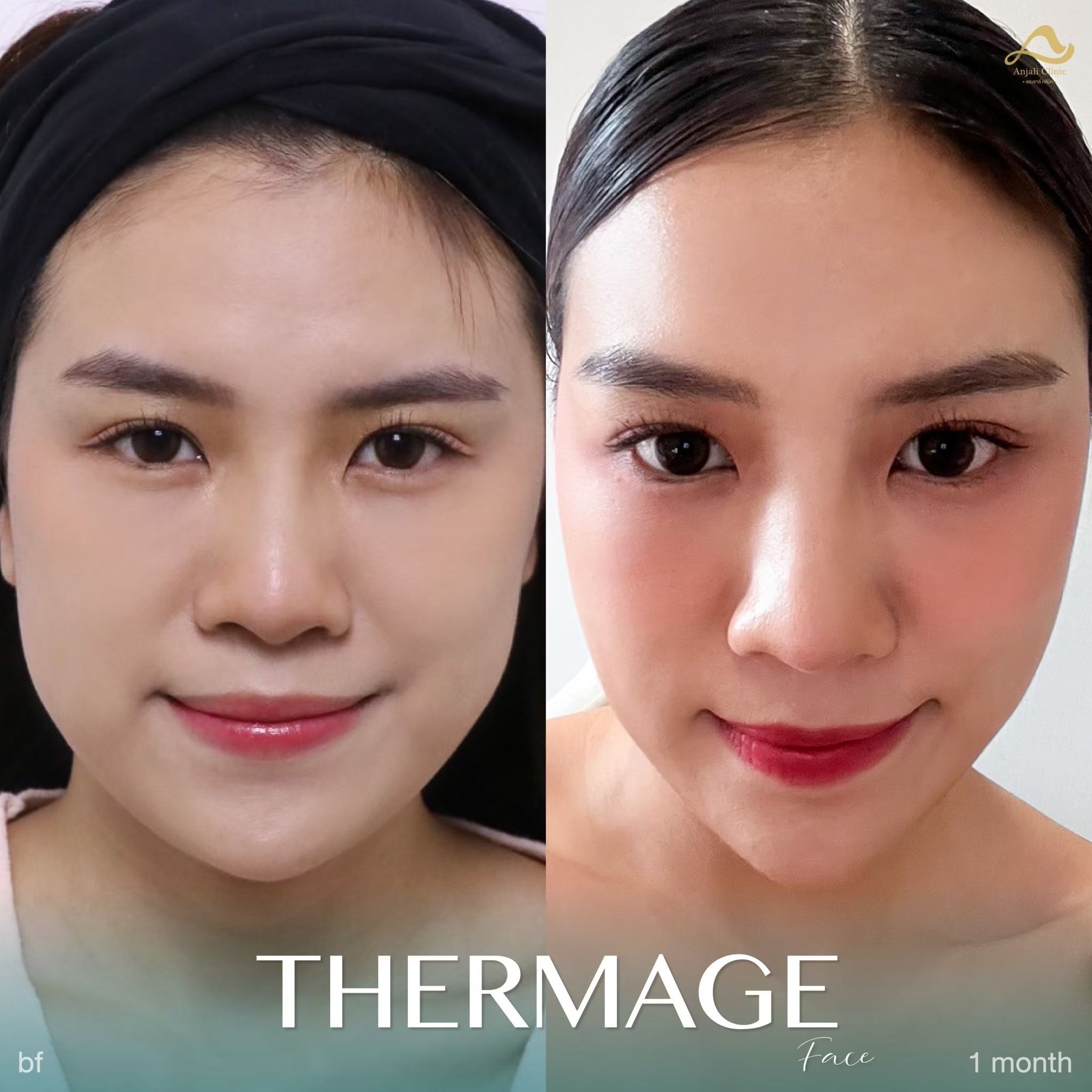 Thermage หน้า 2