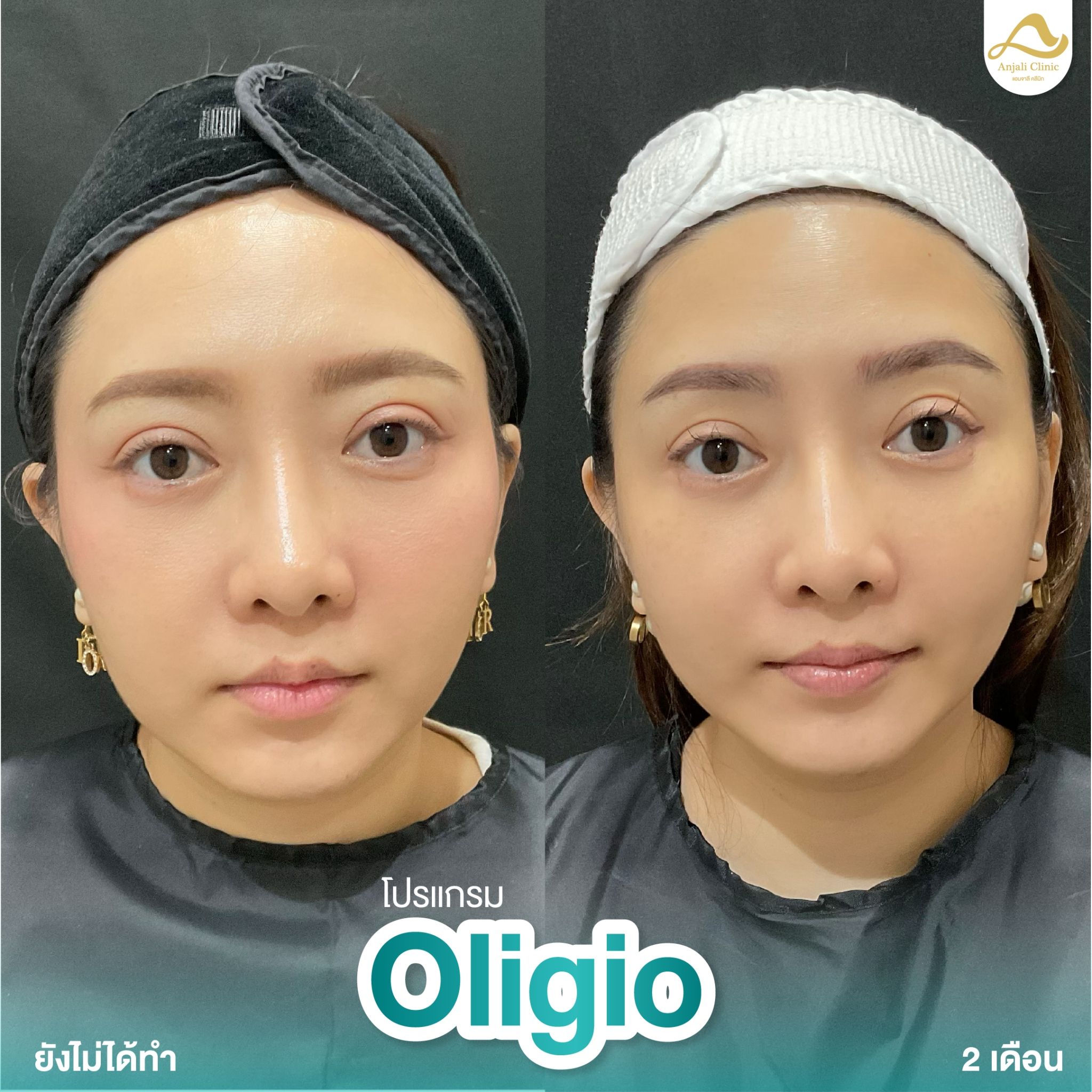 Oligio 9