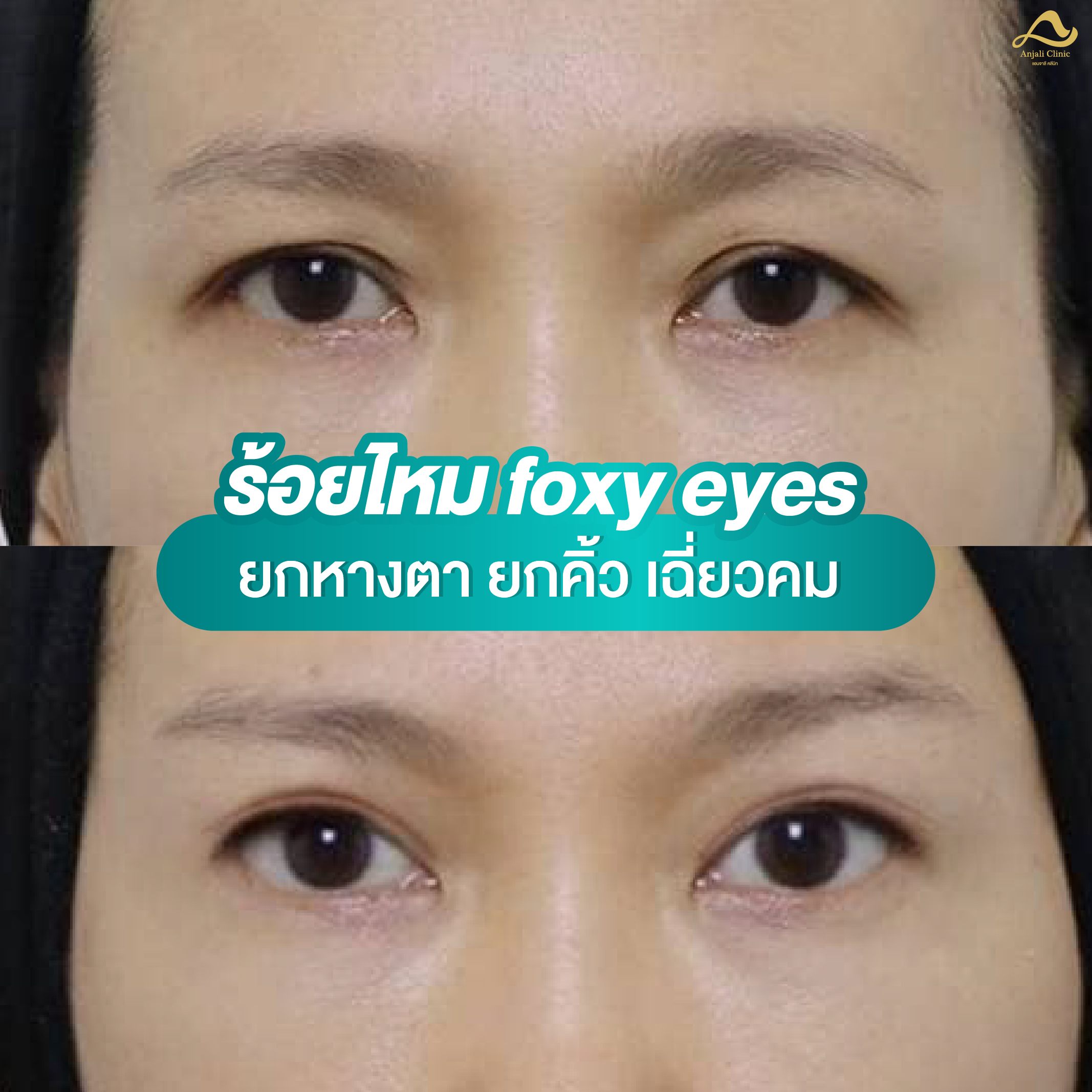 ร้อยไหม Foxy Eyes 1