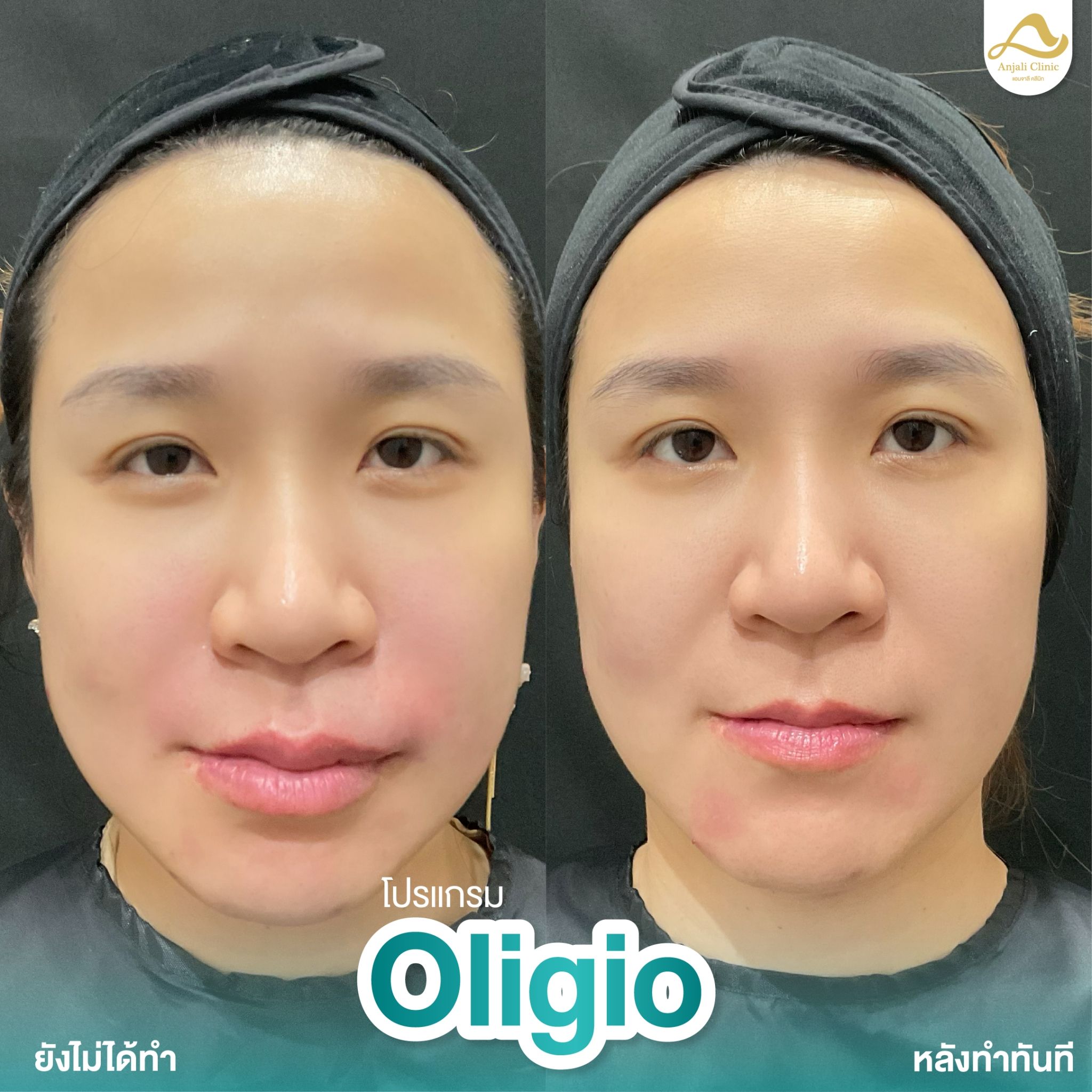 Oligio 3