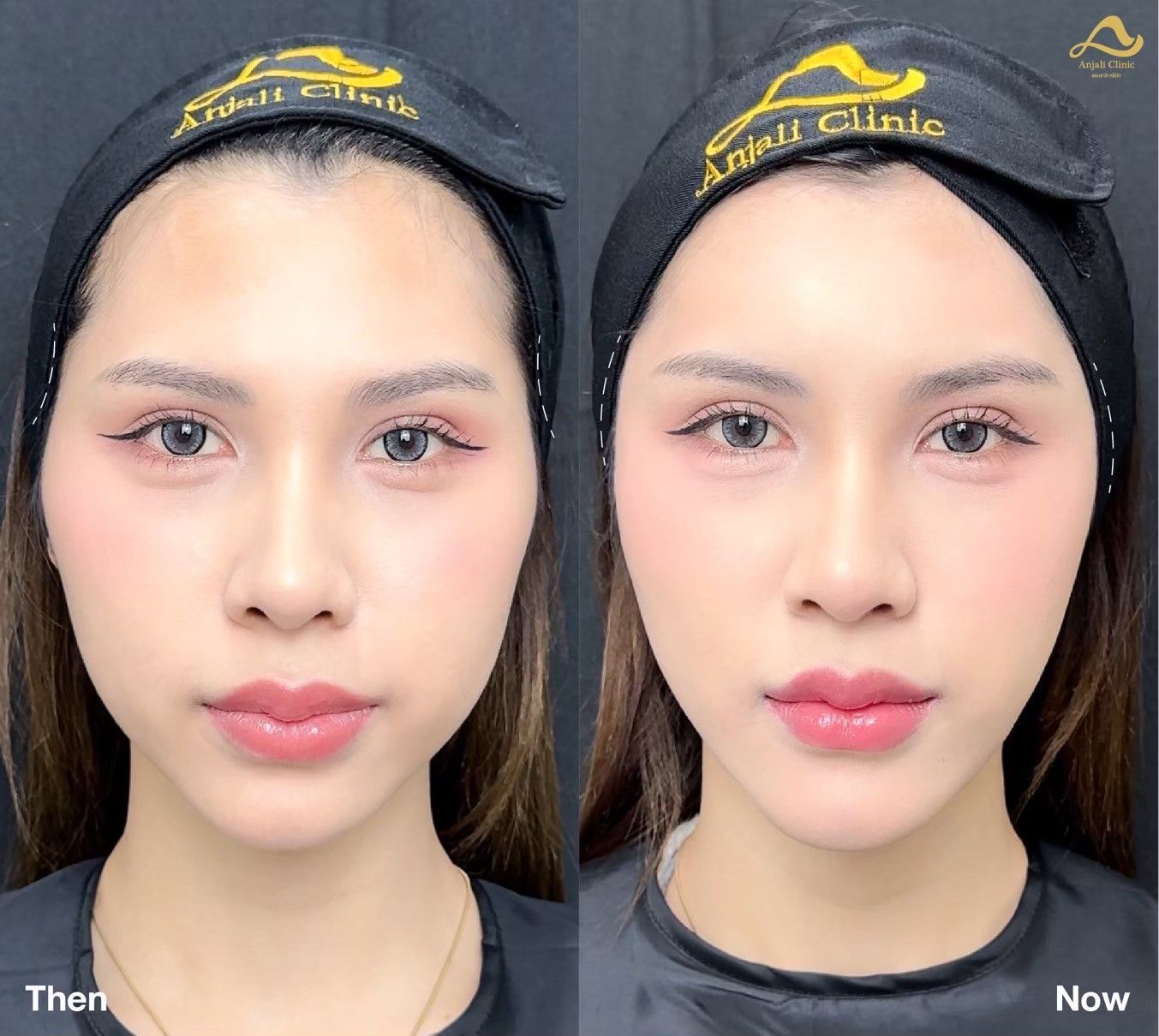 แก้ม 2