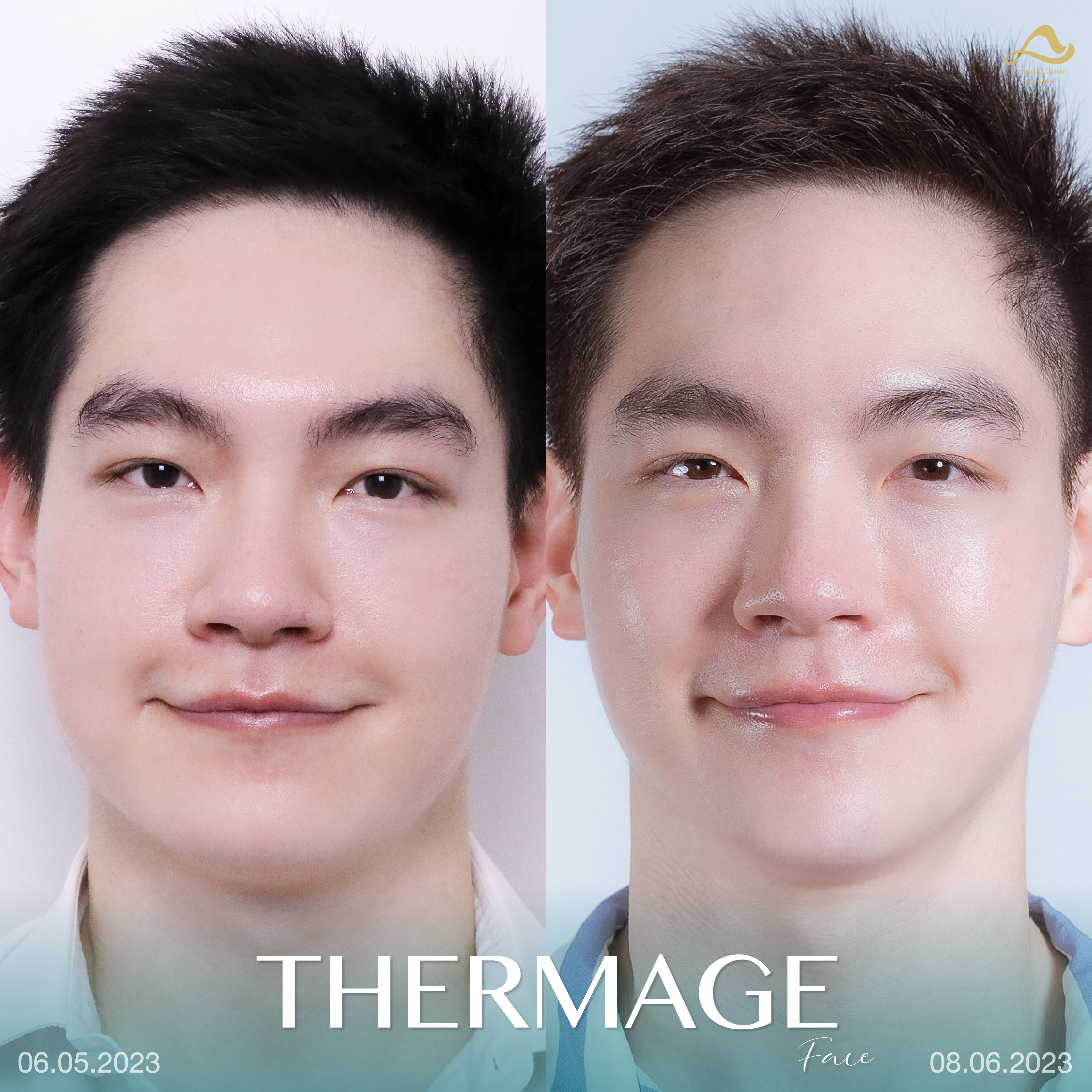 Thermage หน้า 1