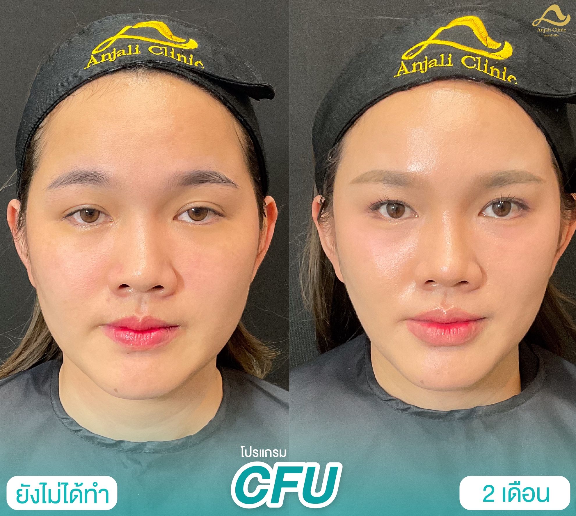 Cfu / Hifu 4