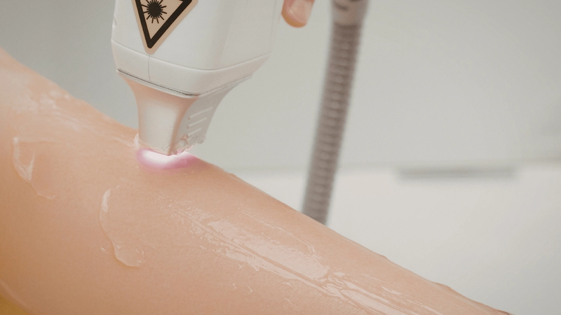 Épilation laser diode avis : est-ce une bonne idée pour le visage et le corps ?