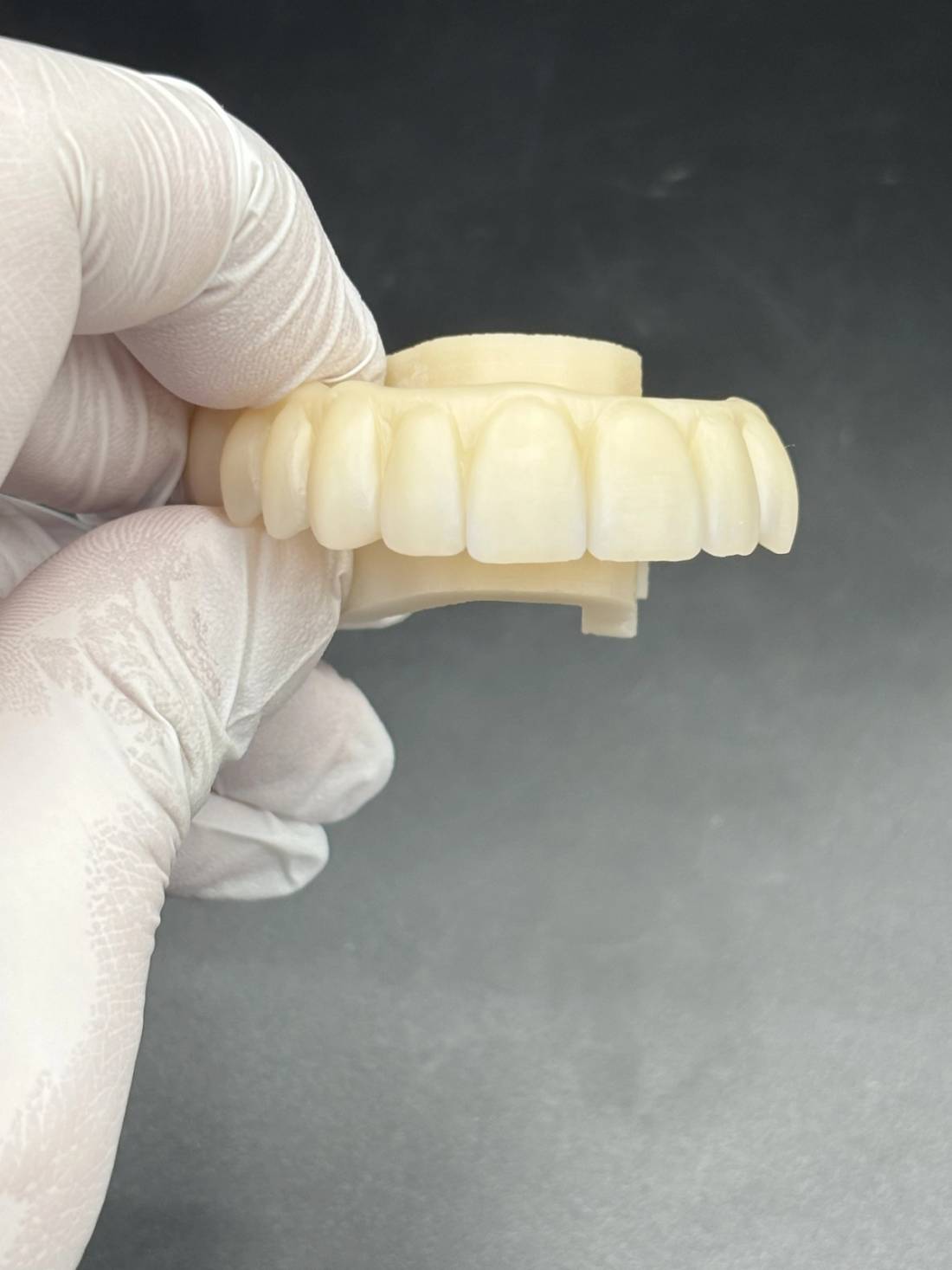 Unprepped All on 6 - Zirconia