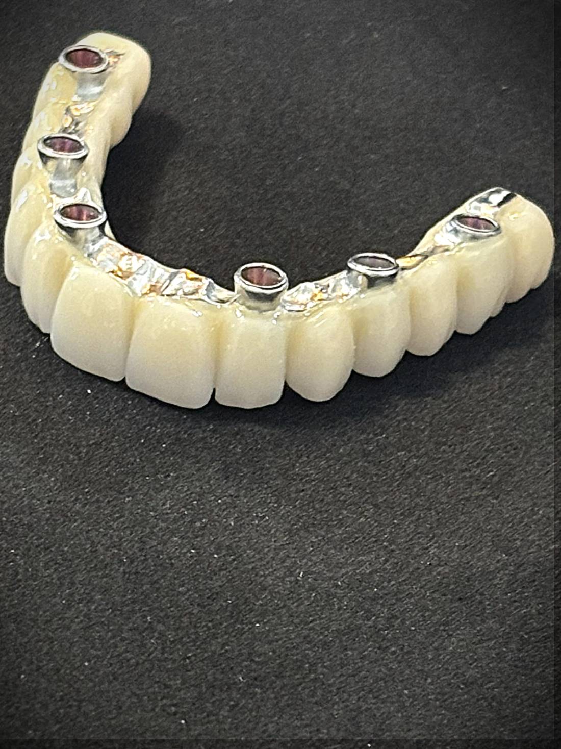 Zirconia Bridge & Tit Bar