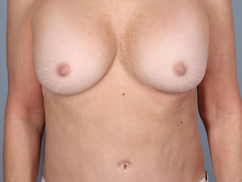 After — Implant Removal and Replacement